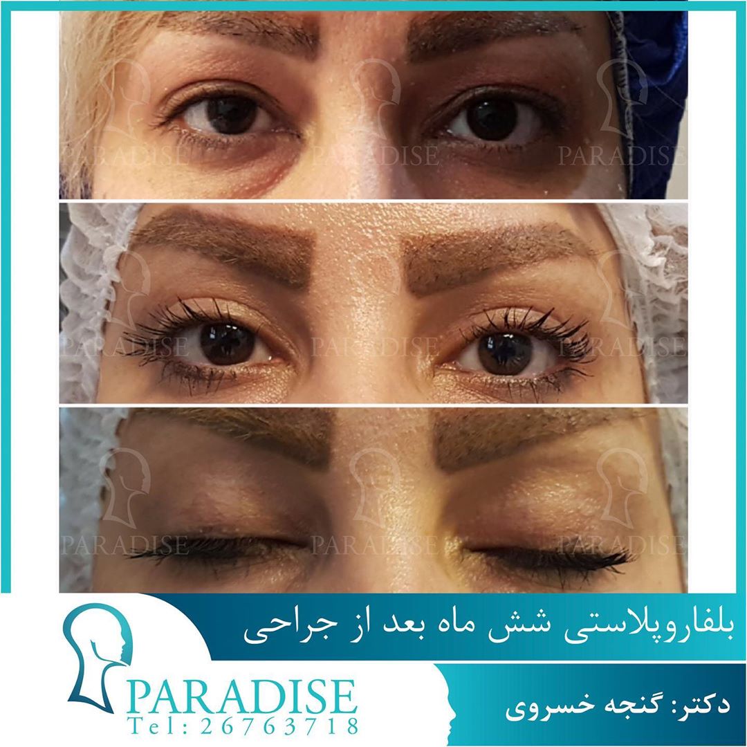 عکس قبل و بعد از عمل بلفارو پلاستی دکتر هومن گنجه خسروی