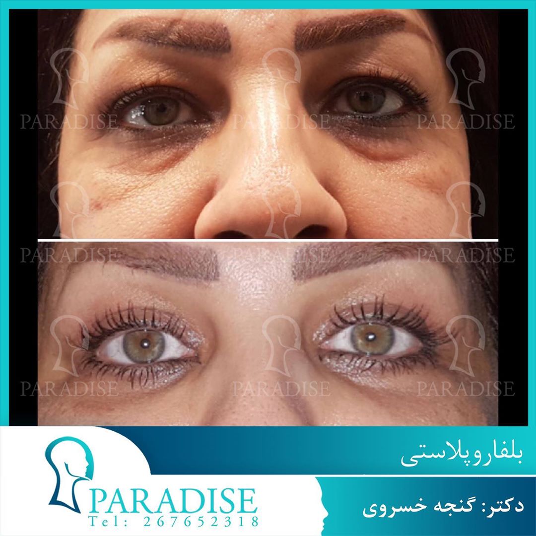 عکس قبل و بعد از عمل بلفارو پلاستی دکتر هومن گنجه خسروی