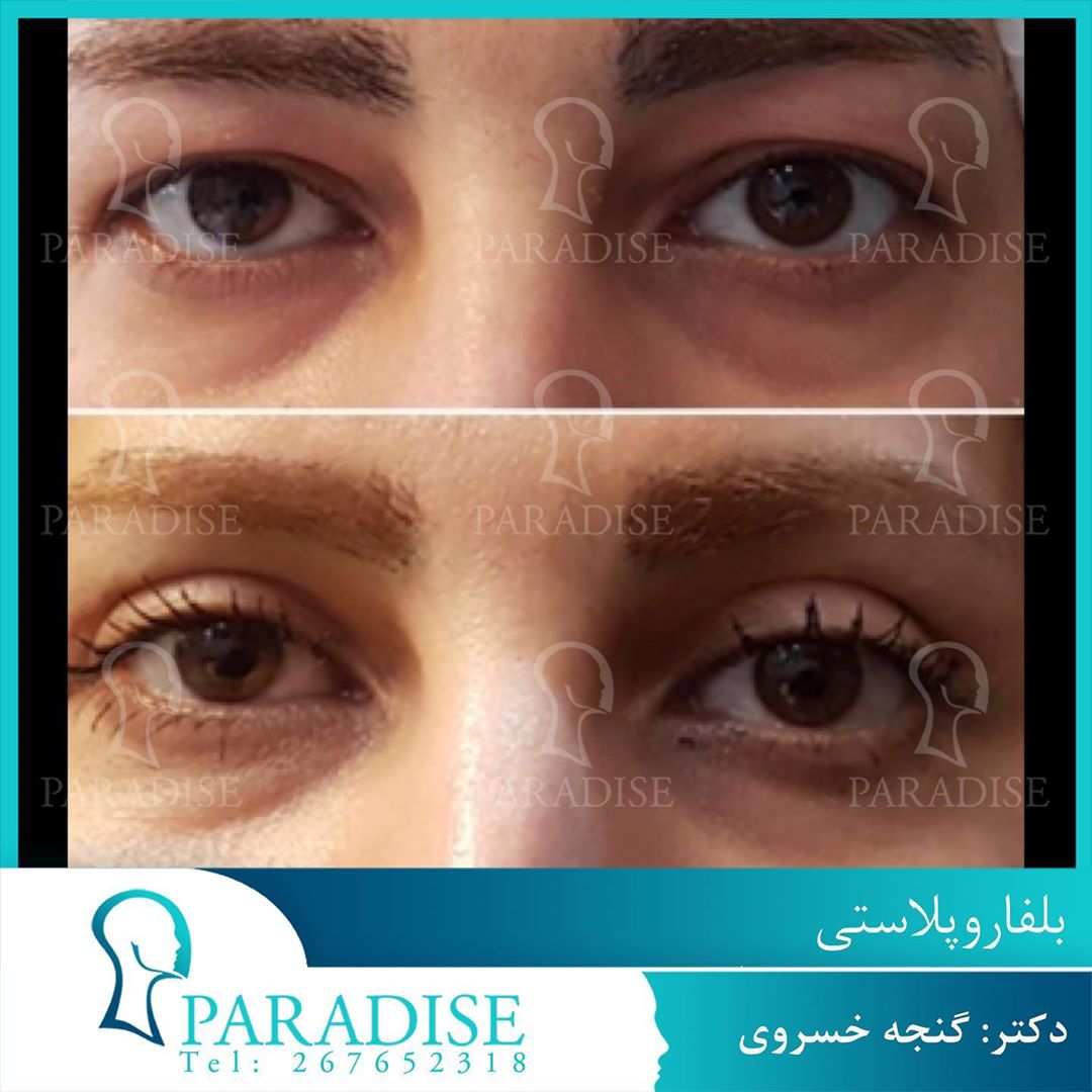 عکس قبل و بعد از عمل بلفارو پلاستی دکتر هومن گنجه خسروی