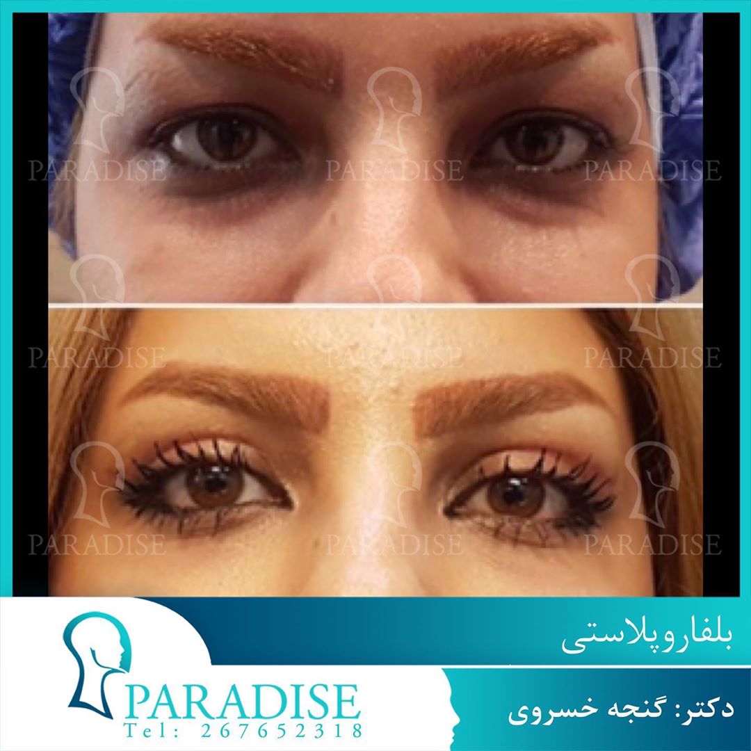 عکس قبل و بعد از عمل بلفارو پلاستی دکتر هومن گنجه خسروی