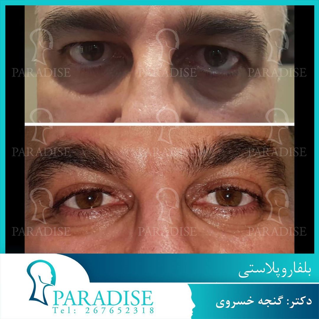 عکس قبل و بعد از عمل بلفارو پلاستی دکتر هومن گنجه خسروی