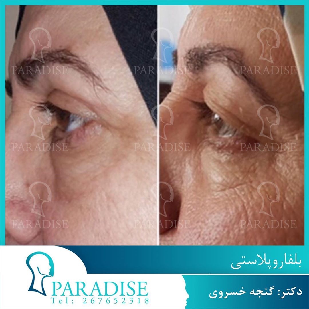 عکس قبل و بعد از عمل بلفارو پلاستی دکتر هومن گنجه خسروی