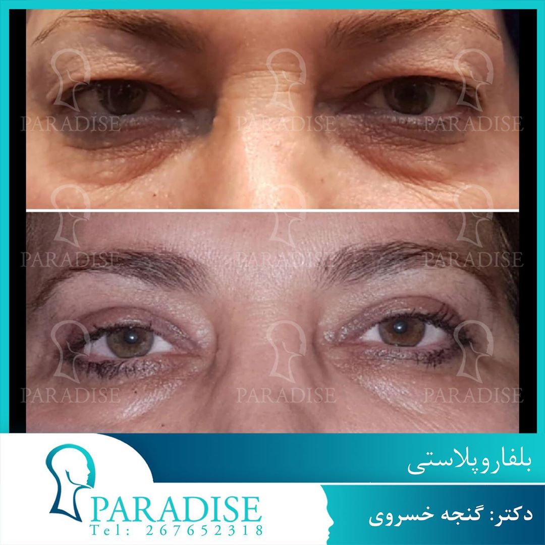عکس قبل و بعد از عمل بلفارو پلاستی دکتر هومن گنجه خسروی