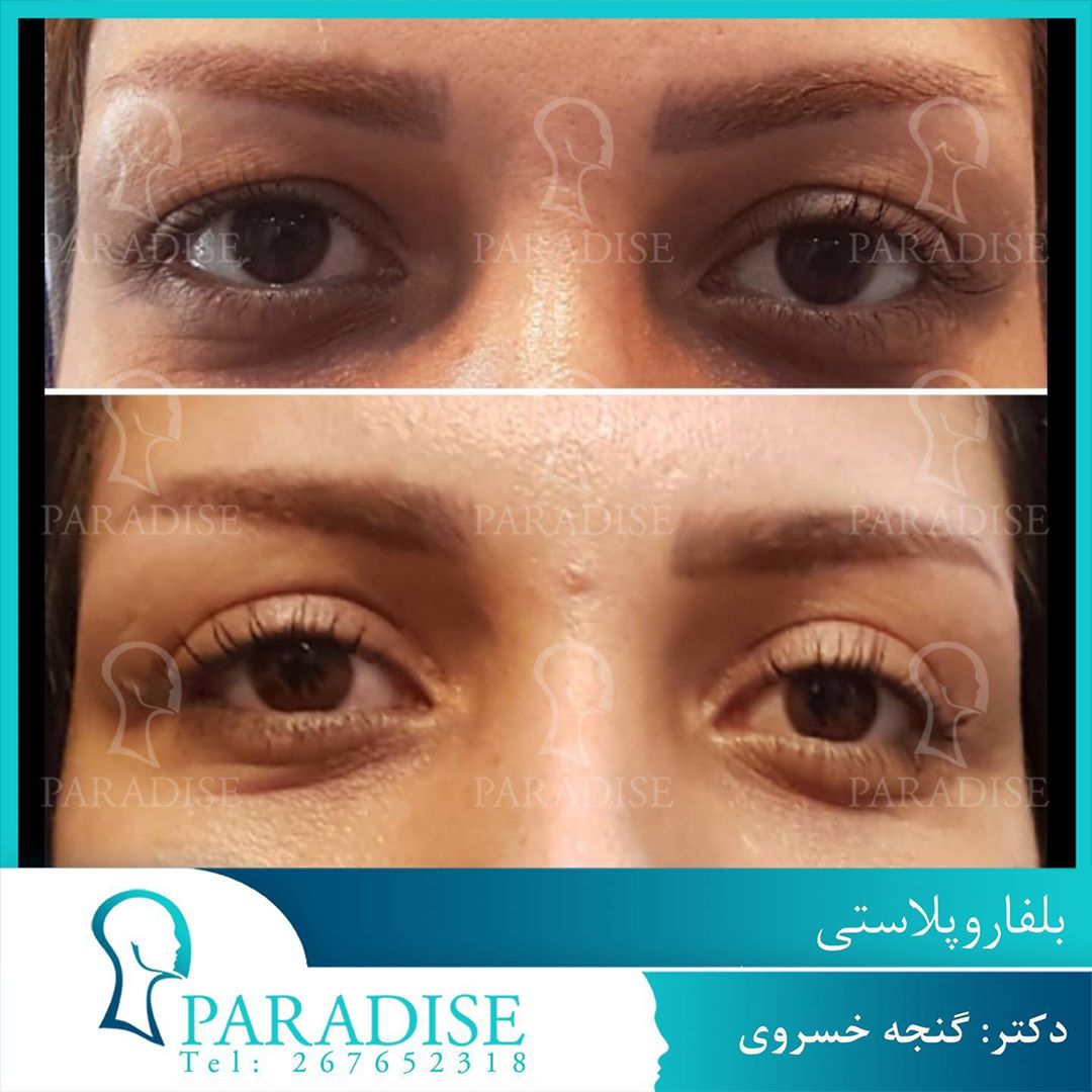 عکس قبل و بعد از عمل بلفارو پلاستی دکتر هومن گنجه خسروی