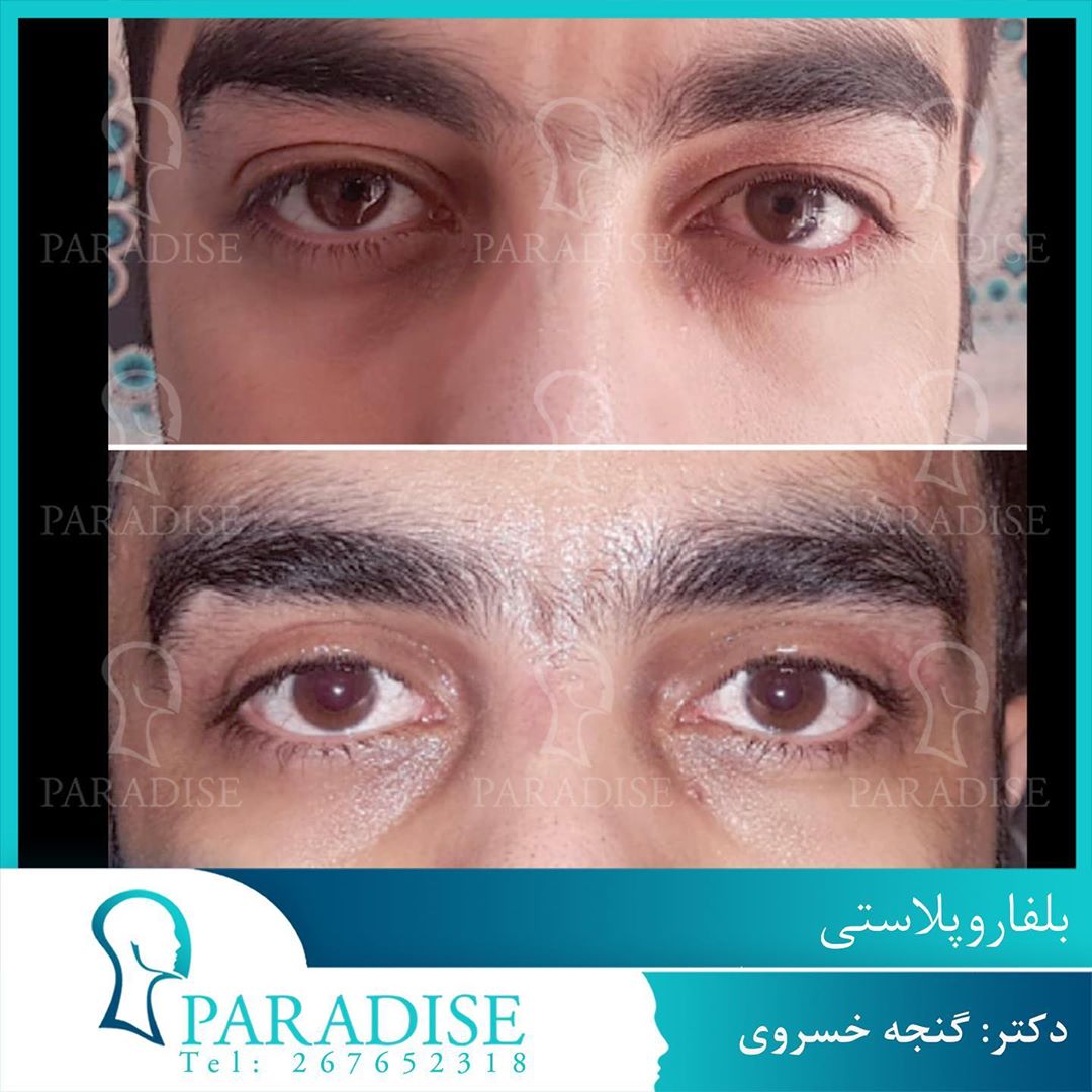 عکس قبل و بعد از عمل بلفارو پلاستی دکتر هومن گنجه خسروی