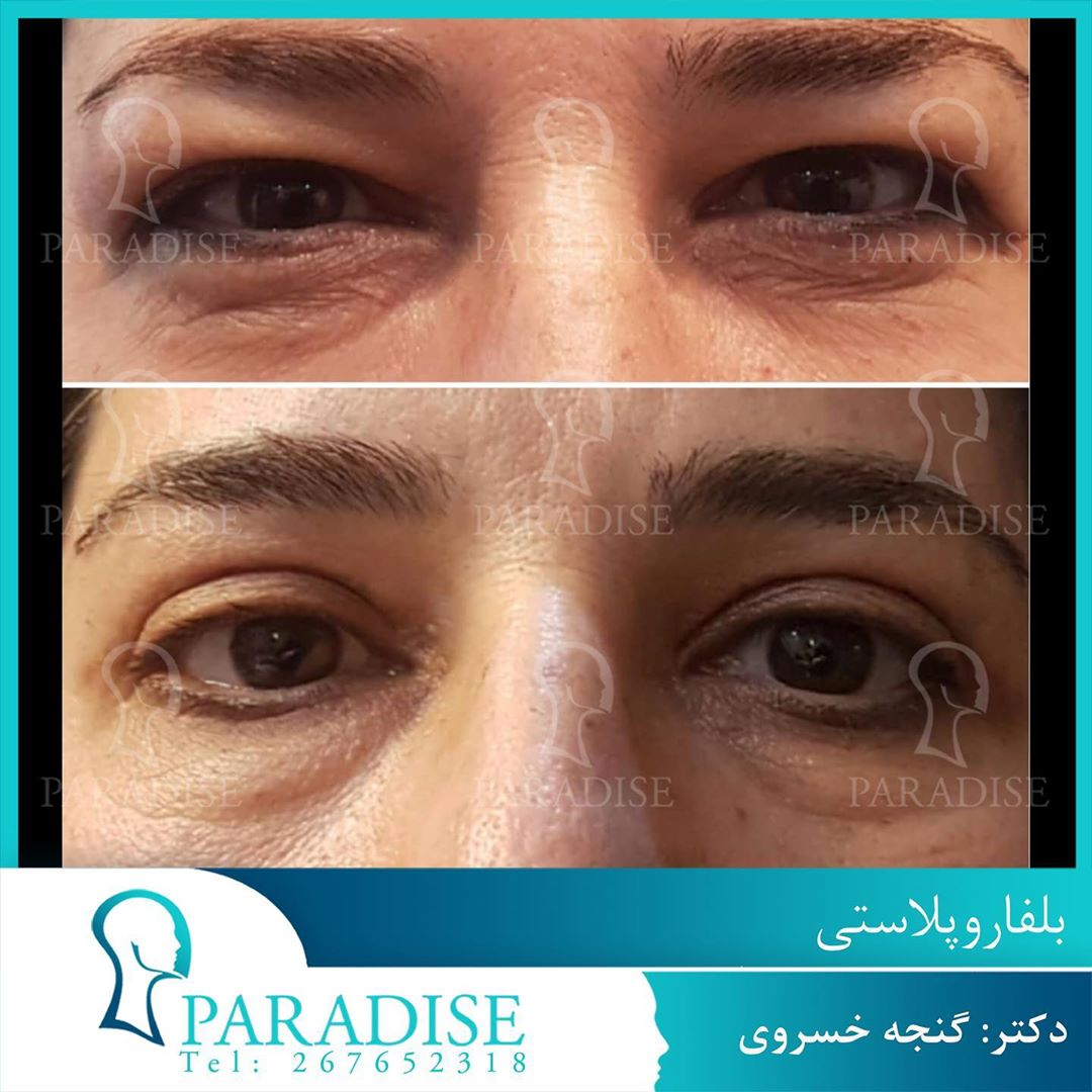 عکس قبل و بعد از عمل بلفارو پلاستی دکتر هومن گنجه خسروی