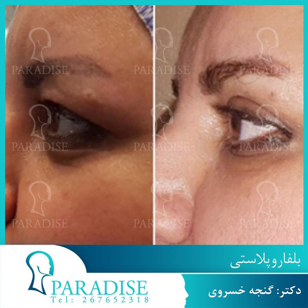 عکس قبل و بعد از عمل بلفارو پلاستی دکتر هومن گنجه خسروی