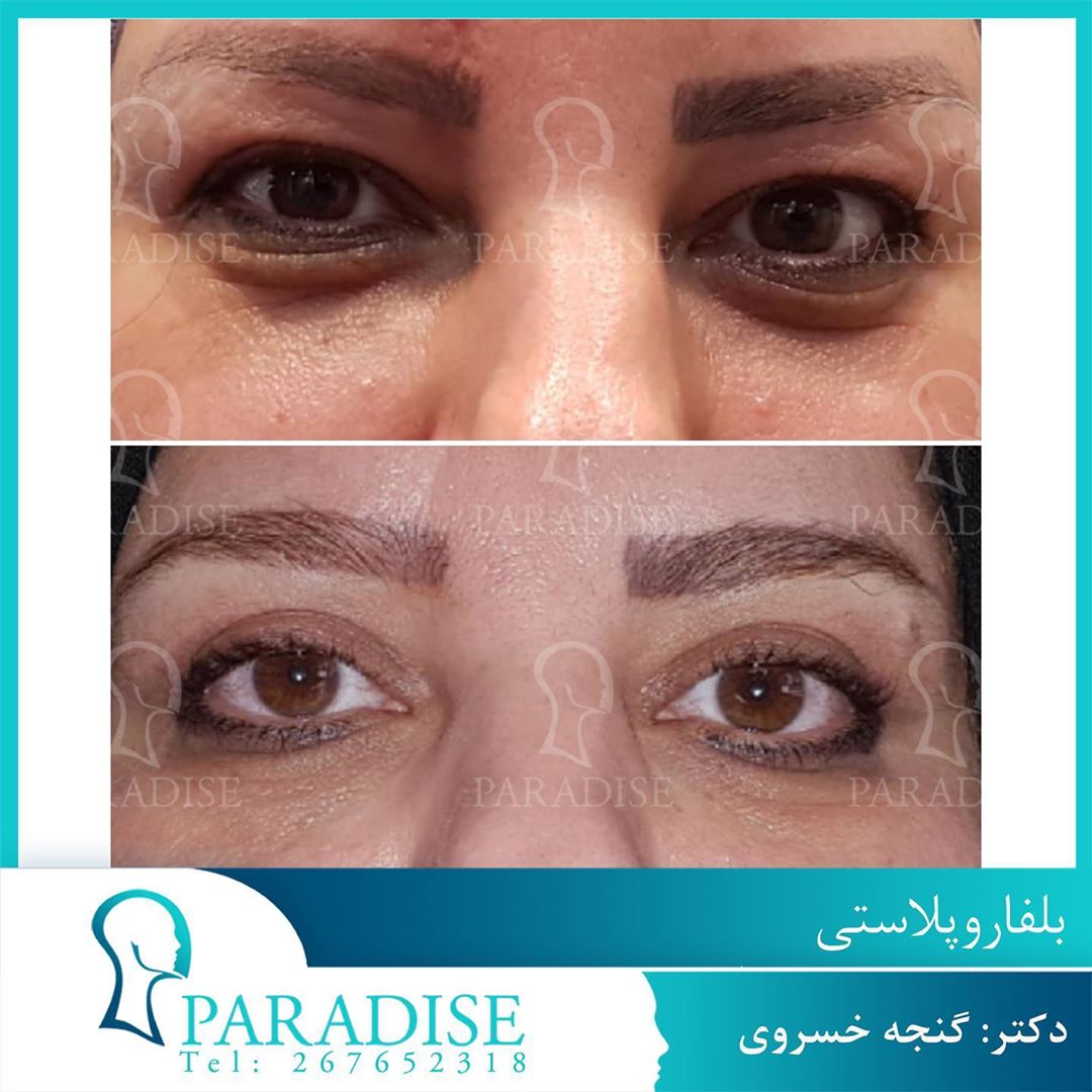 عکس قبل و بعد از عمل بلفارو پلاستی دکتر هومن گنجه خسروی