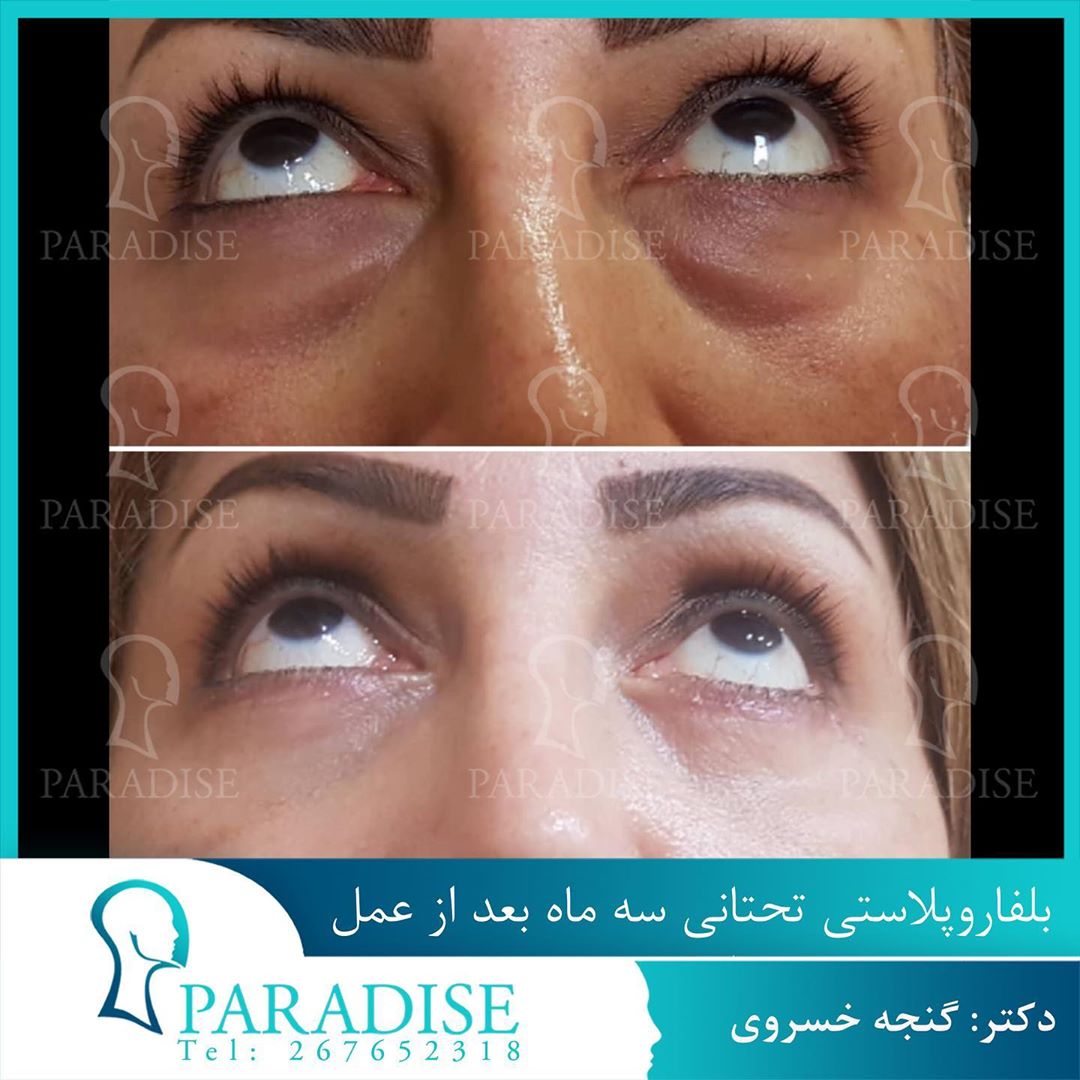 عکس قبل و بعد از عمل بلفارو پلاستی دکتر هومن گنجه خسروی