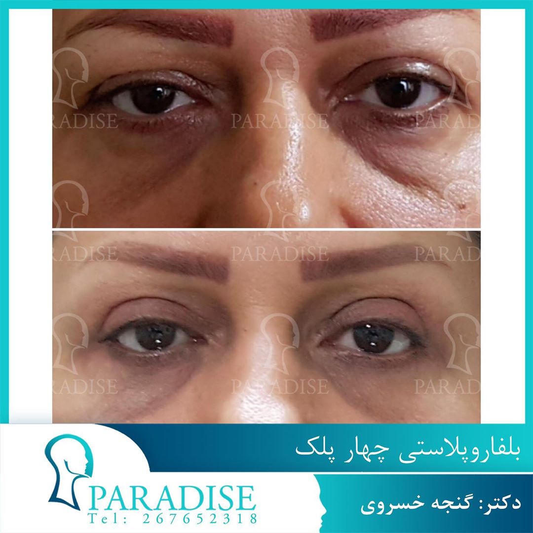 عکس قبل و بعد از عمل بلفارو پلاستی دکتر هومن گنجه خسروی