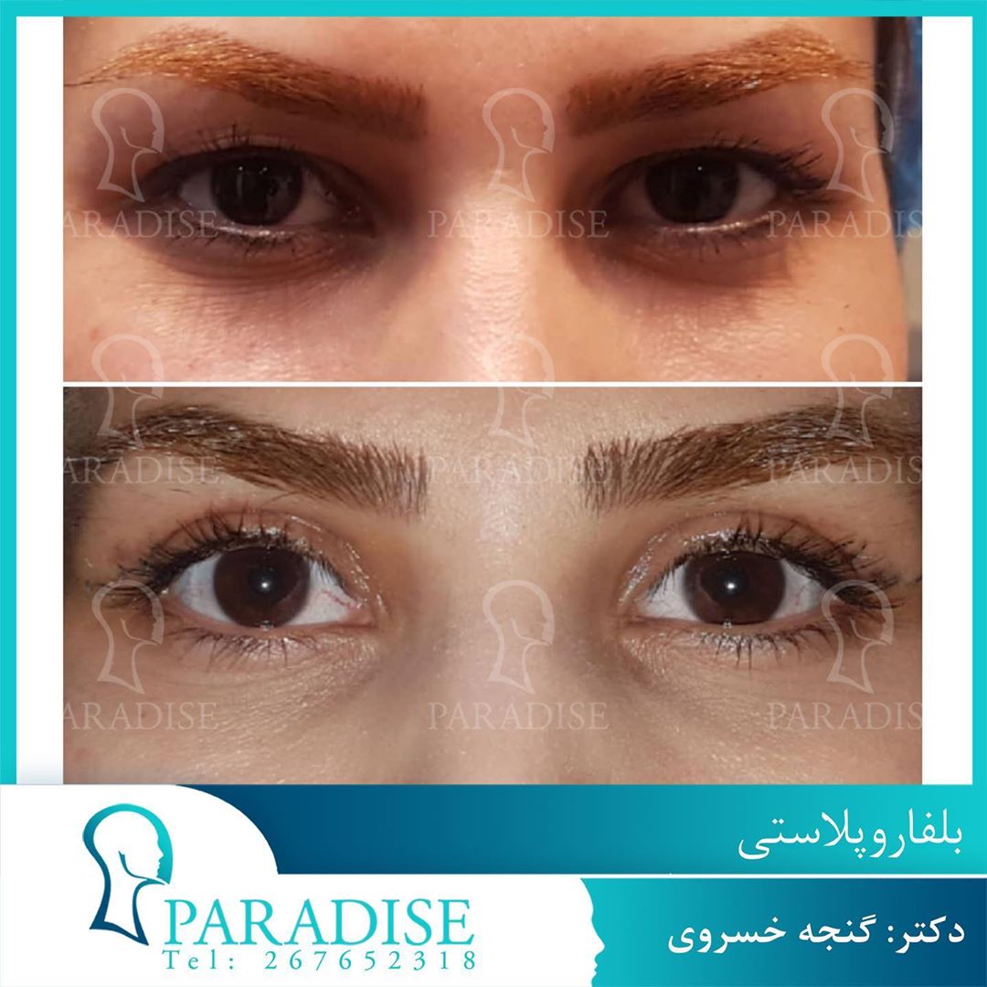 عکس قبل و بعد از عمل بلفارو پلاستی دکتر هومن گنجه خسروی