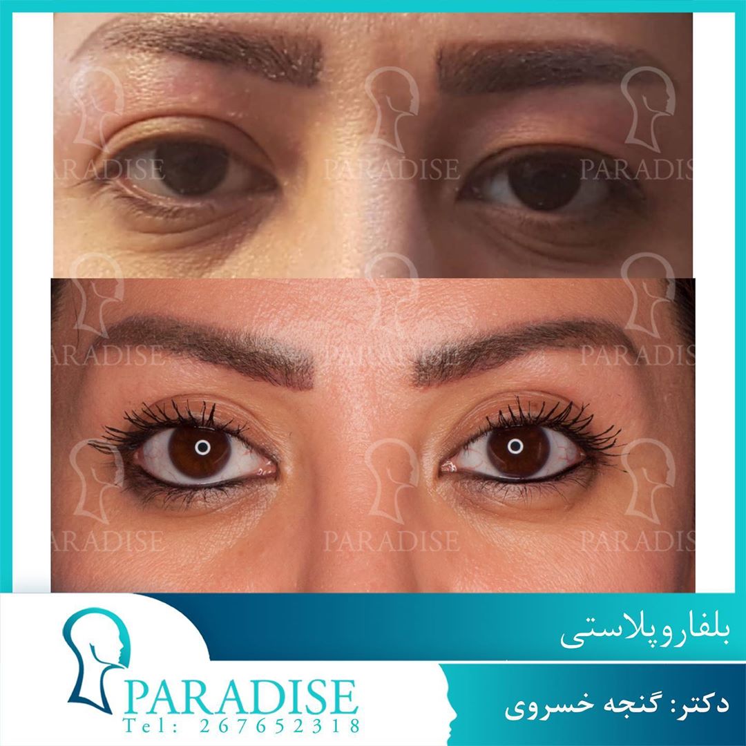 عکس قبل و بعد از عمل بلفارو پلاستی دکتر هومن گنجه خسروی