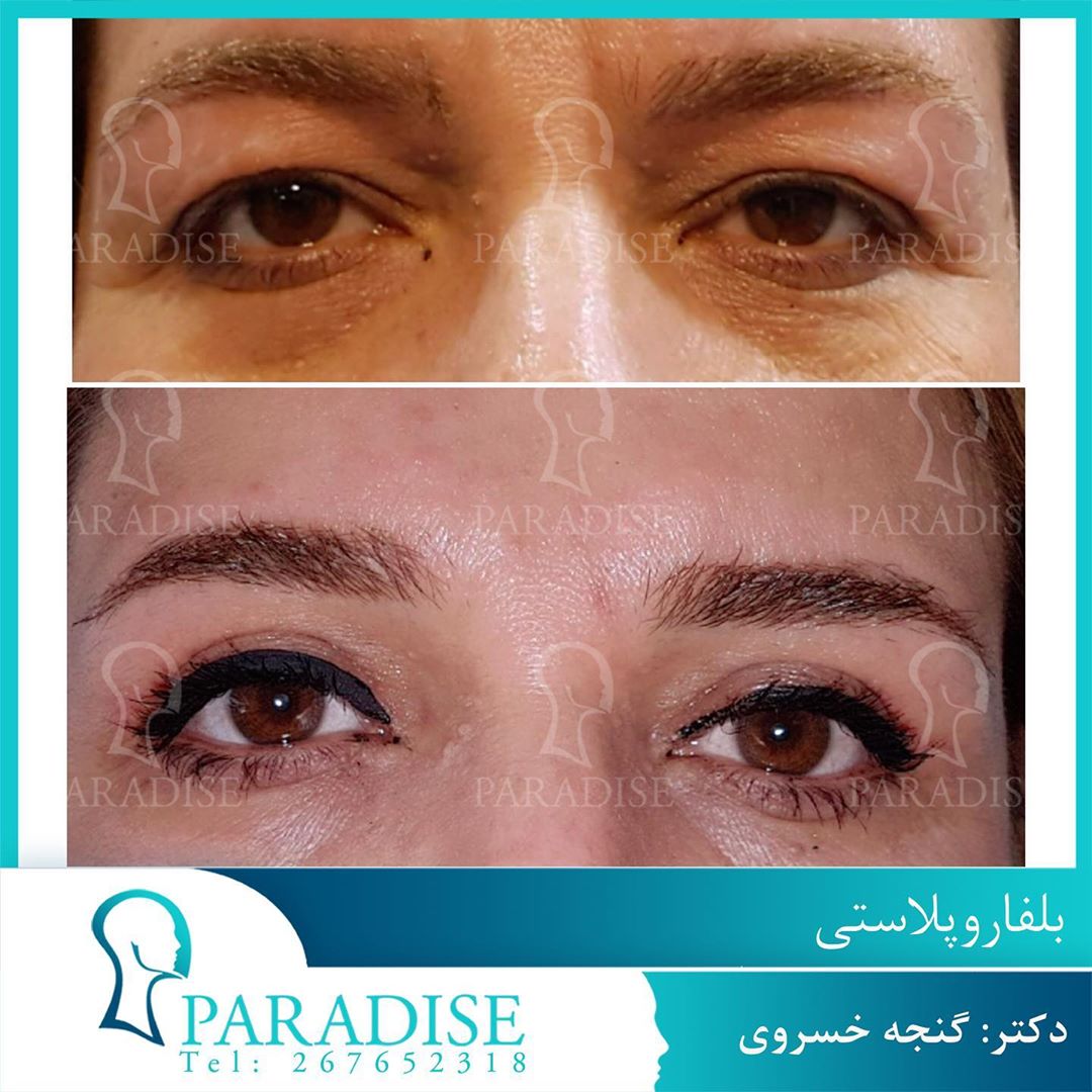 عکس قبل و بعد از عمل بلفارو پلاستی دکتر هومن گنجه خسروی