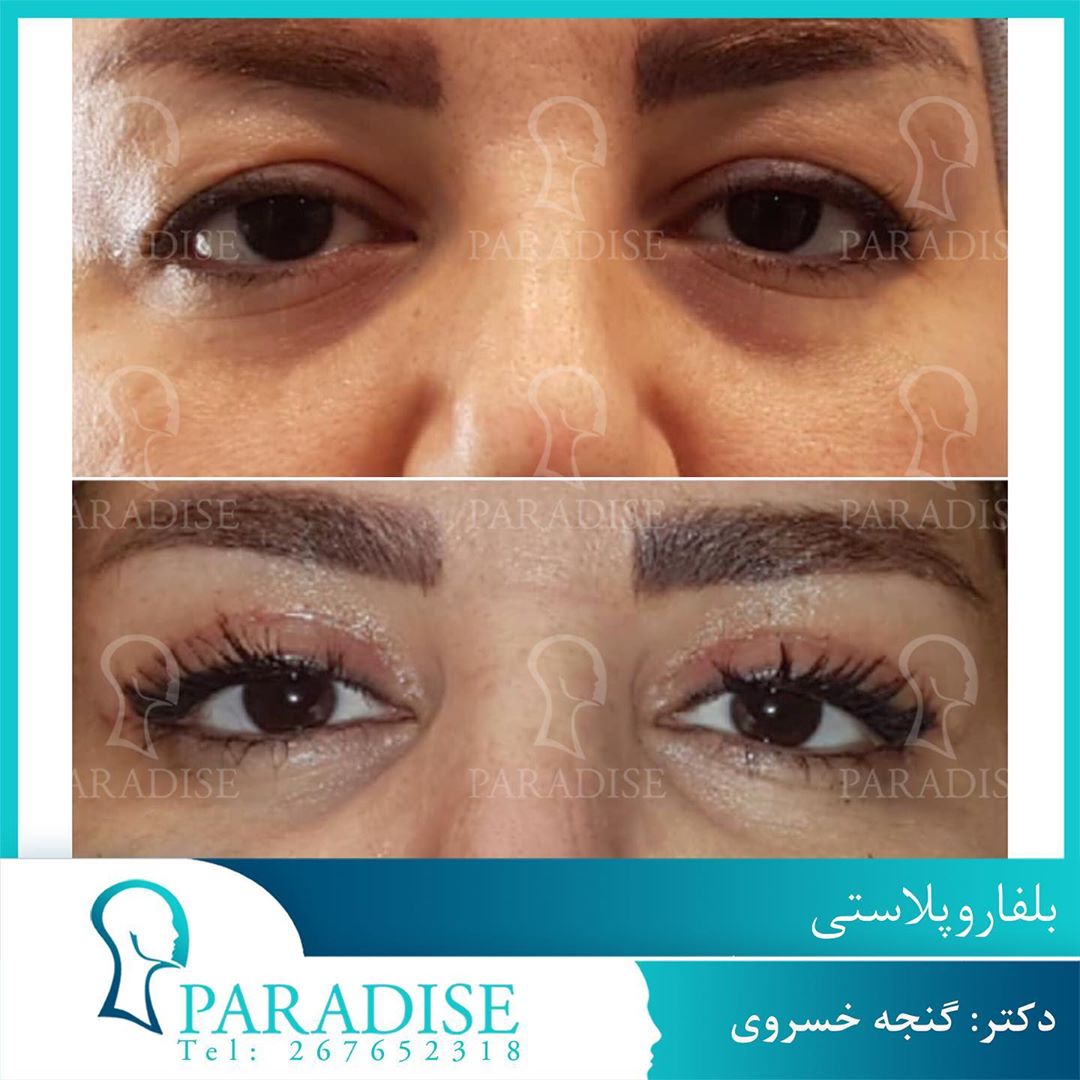 عکس قبل و بعد از عمل بلفارو پلاستی دکتر هومن گنجه خسروی