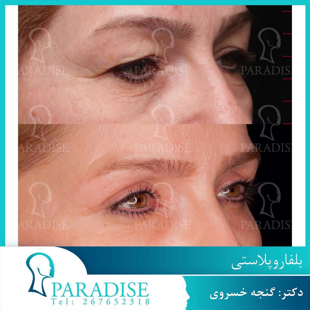 عکس قبل و بعد از عمل بلفارو پلاستی دکتر هومن گنجه خسروی