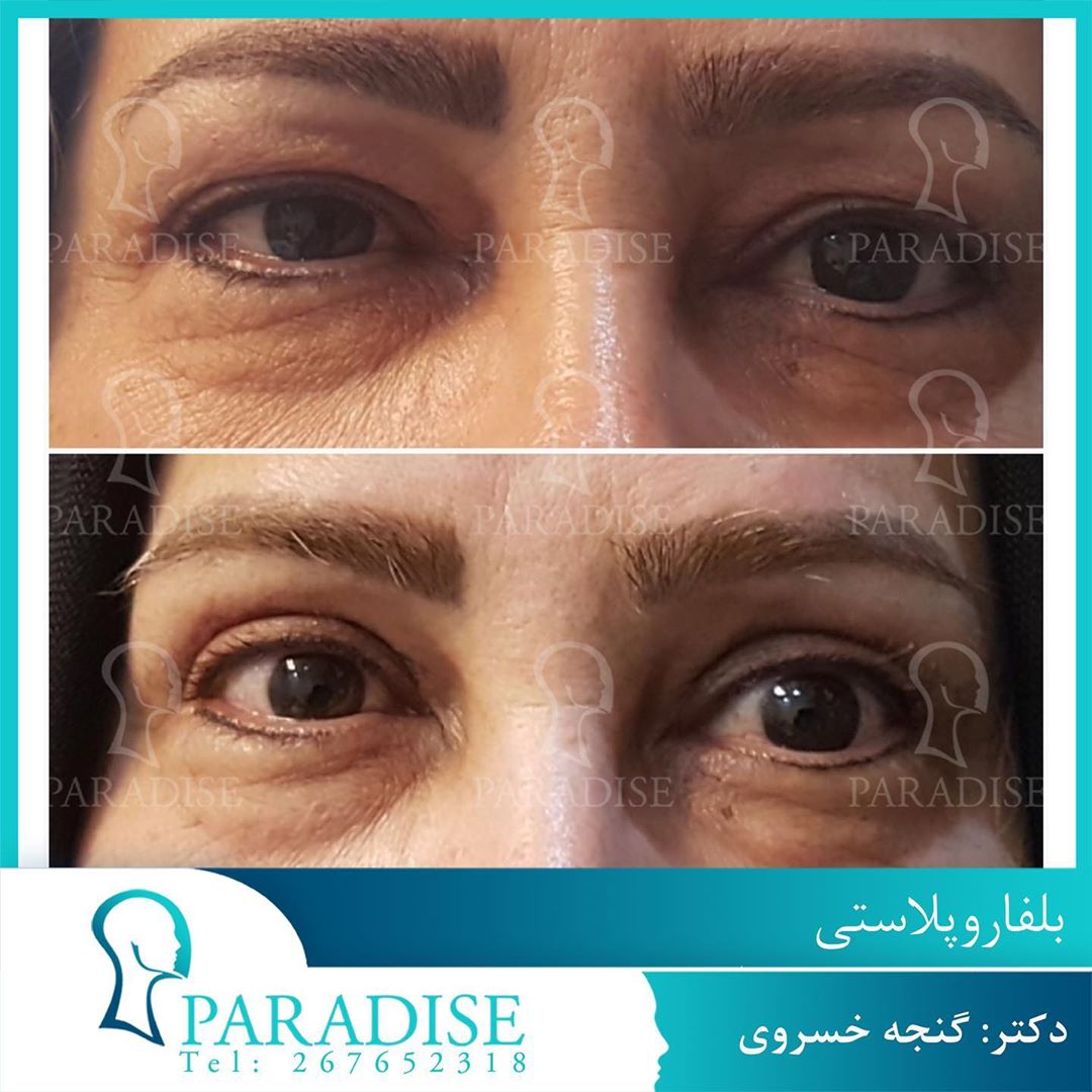 عکس قبل و بعد از عمل بلفارو پلاستی دکتر هومن گنجه خسروی