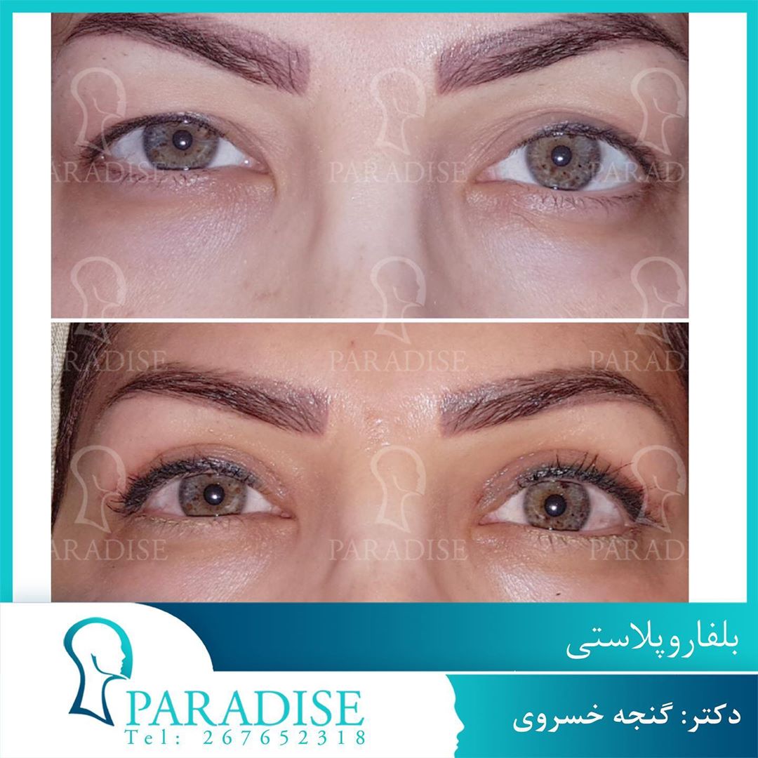 عکس قبل و بعد از عمل بلفارو پلاستی دکتر هومن گنجه خسروی