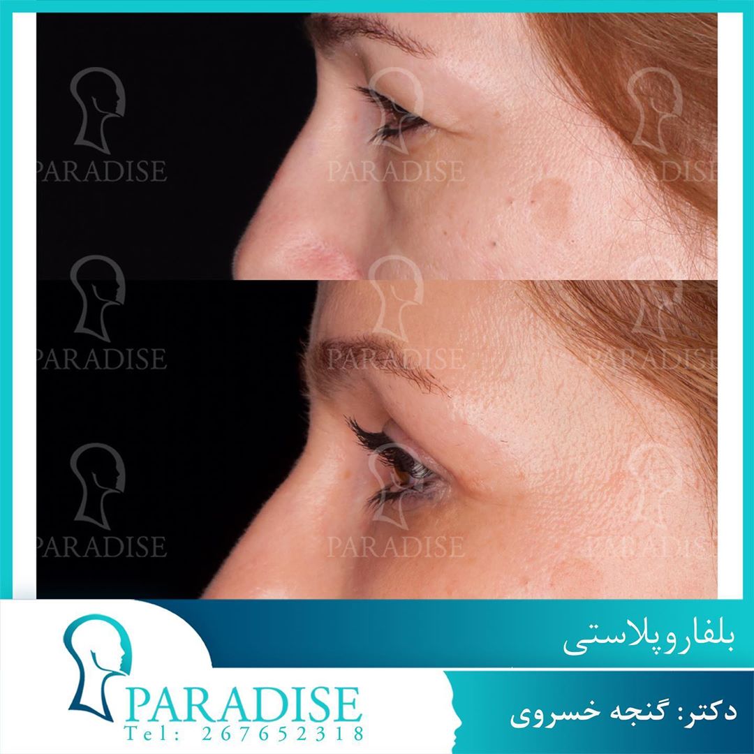 عکس قبل و بعد از عمل بلفارو پلاستی دکتر هومن گنجه خسروی