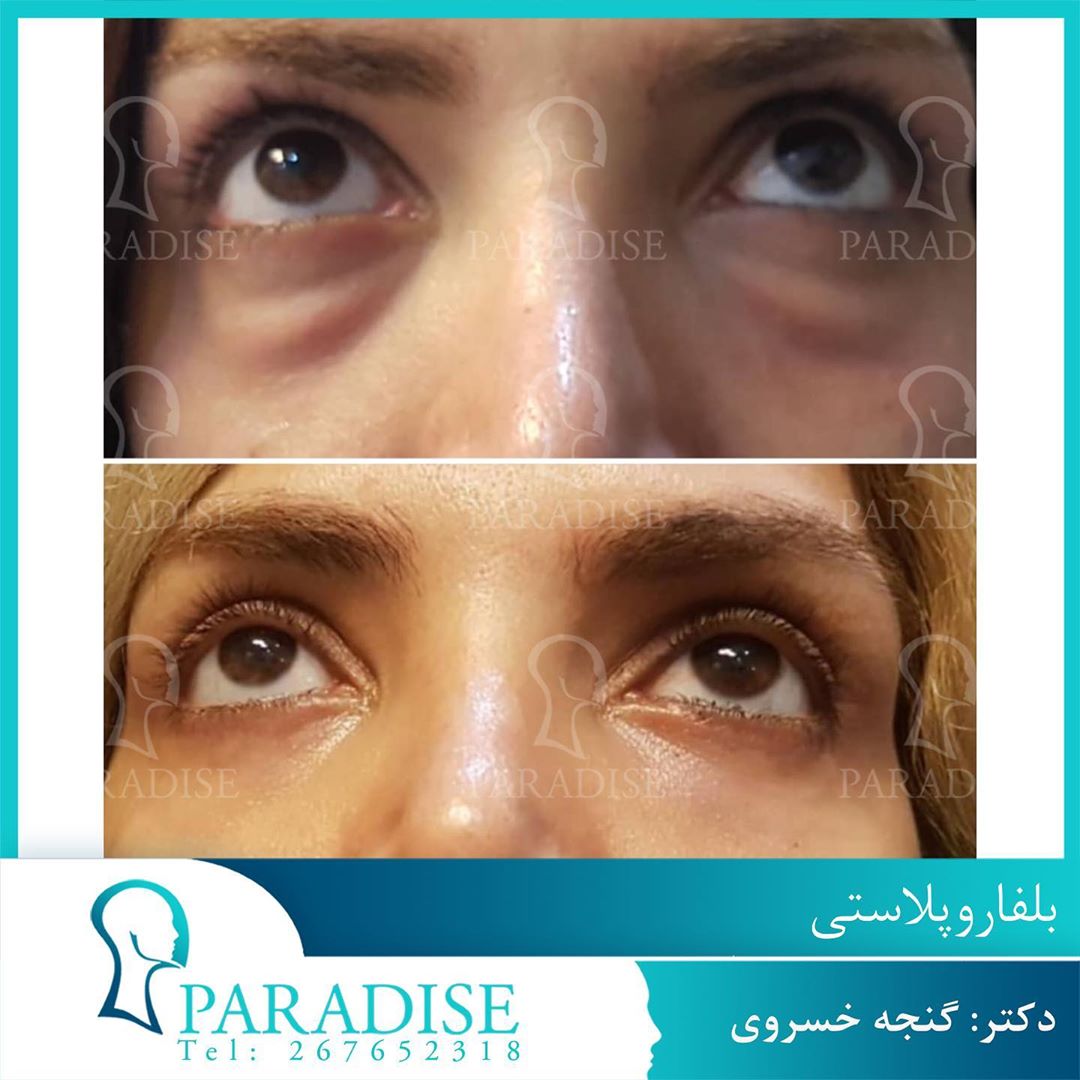 عکس قبل و بعد از عمل بلفارو پلاستی دکتر هومن گنجه خسروی