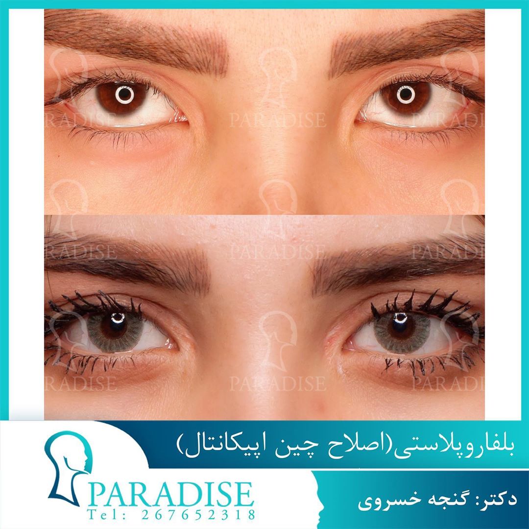 عکس قبل و بعد از عمل بلفارو پلاستی دکتر هومن گنجه خسروی