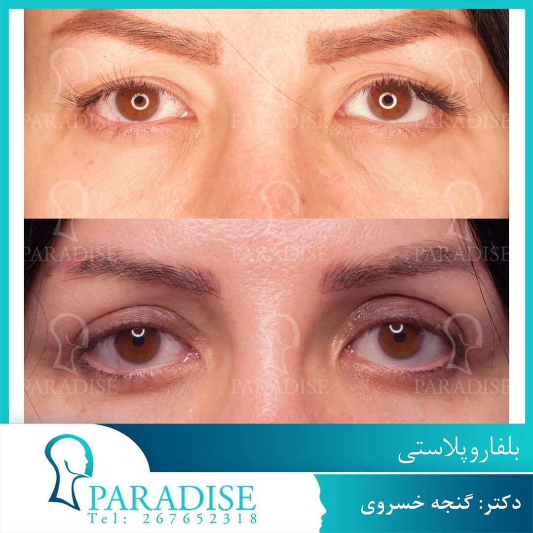 عکس قبل و بعد از عمل بلفارو پلاستی دکتر هومن گنجه خسروی