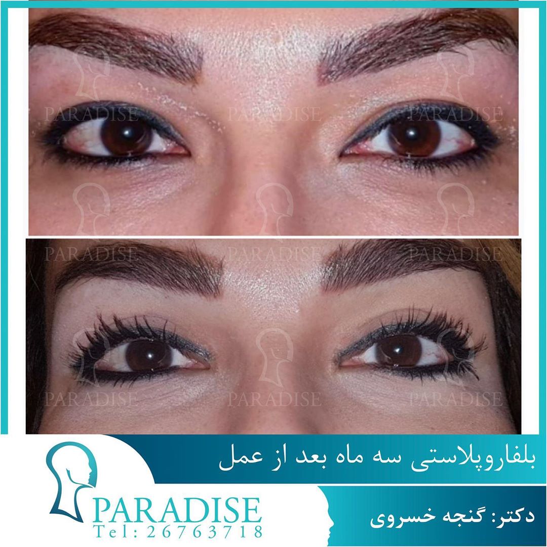 عکس قبل و بعد از عمل بلفارو پلاستی دکتر هومن گنجه خسروی