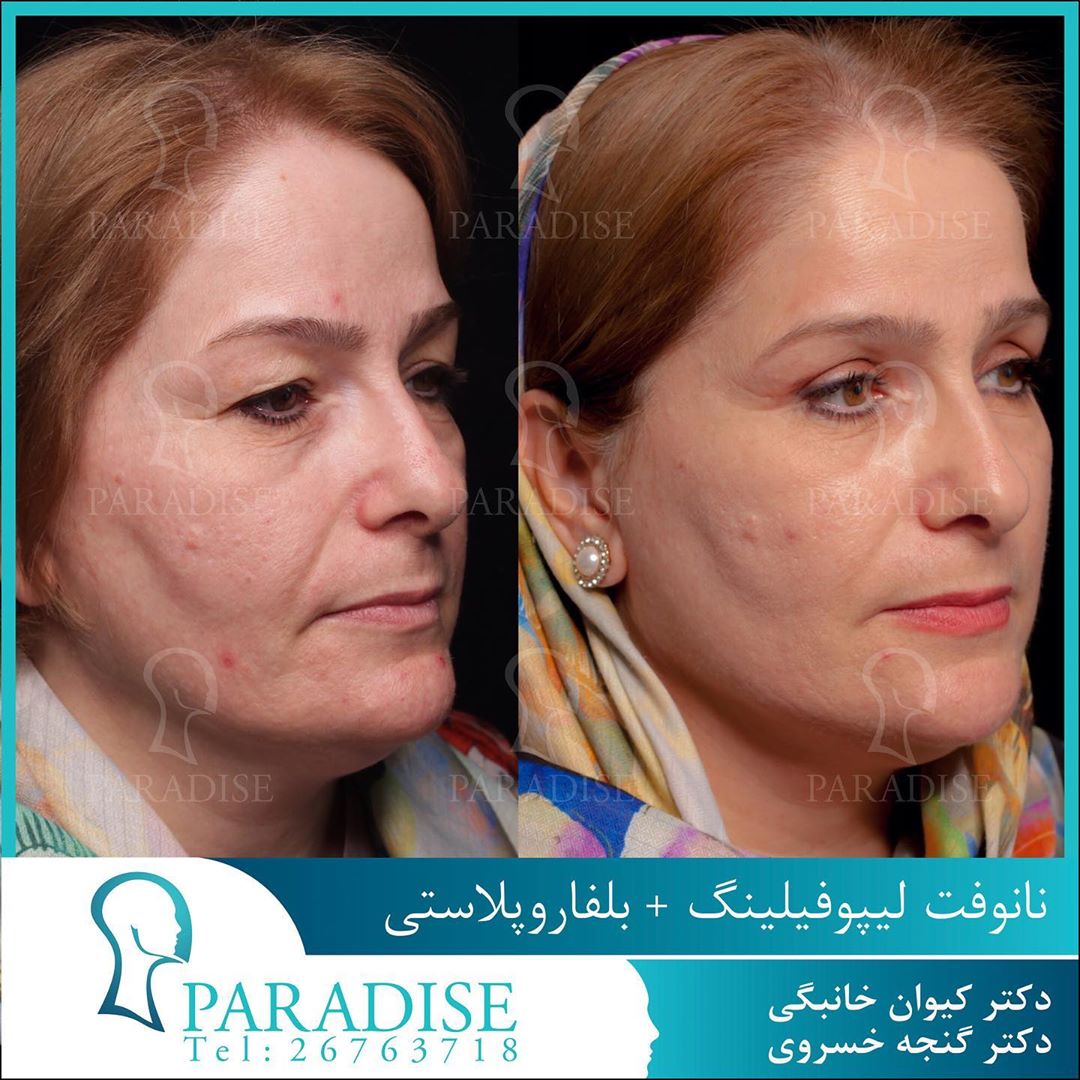 عکس قبل و بعد از عمل بلفارو پلاستی دکتر هومن گنجه خسروی