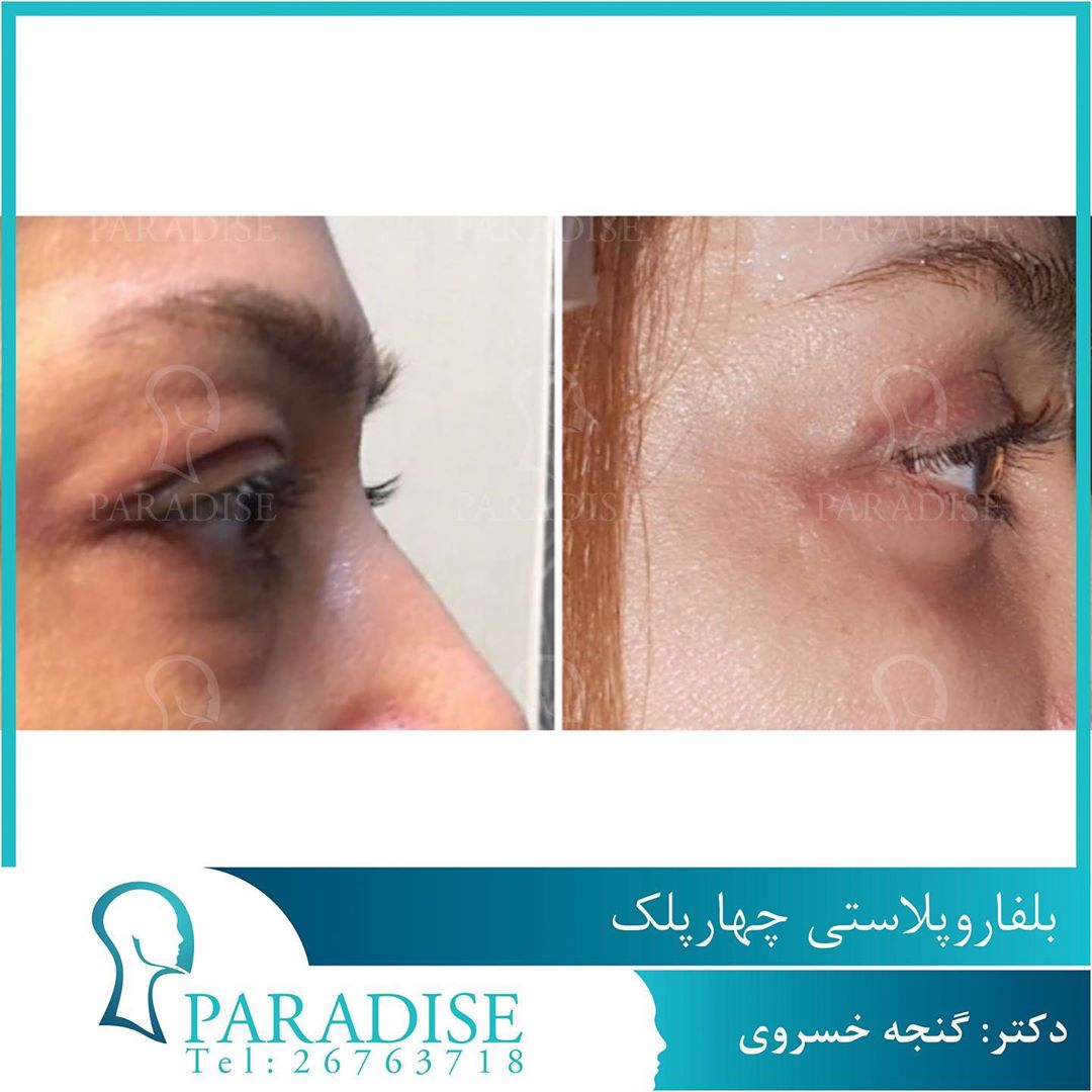 عکس قبل و بعد از عمل بلفارو پلاستی دکتر هومن گنجه خسروی