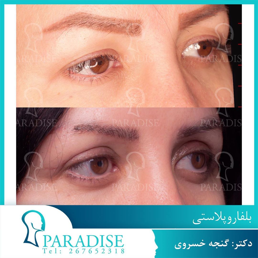 عکس قبل و بعد از عمل بلفارو پلاستی دکتر هومن گنجه خسروی