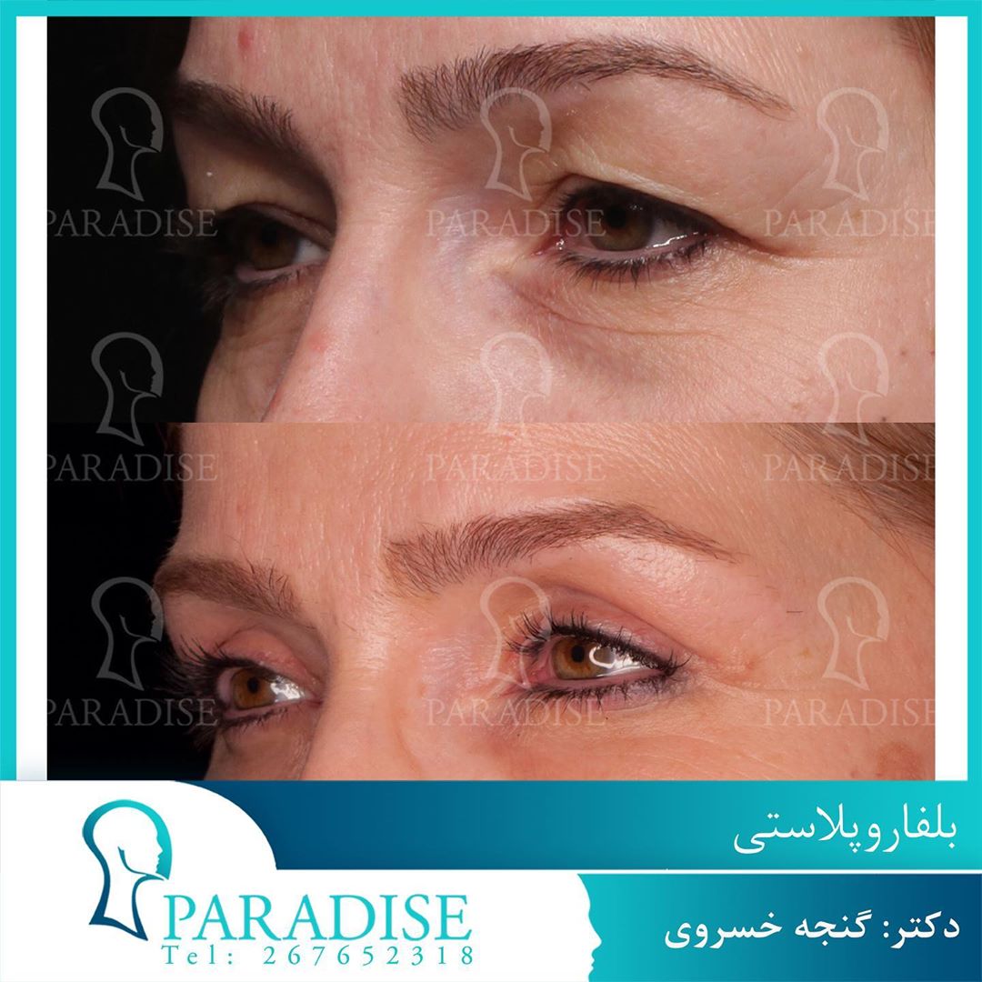 عکس قبل و بعد از عمل بلفارو پلاستی دکتر هومن گنجه خسروی