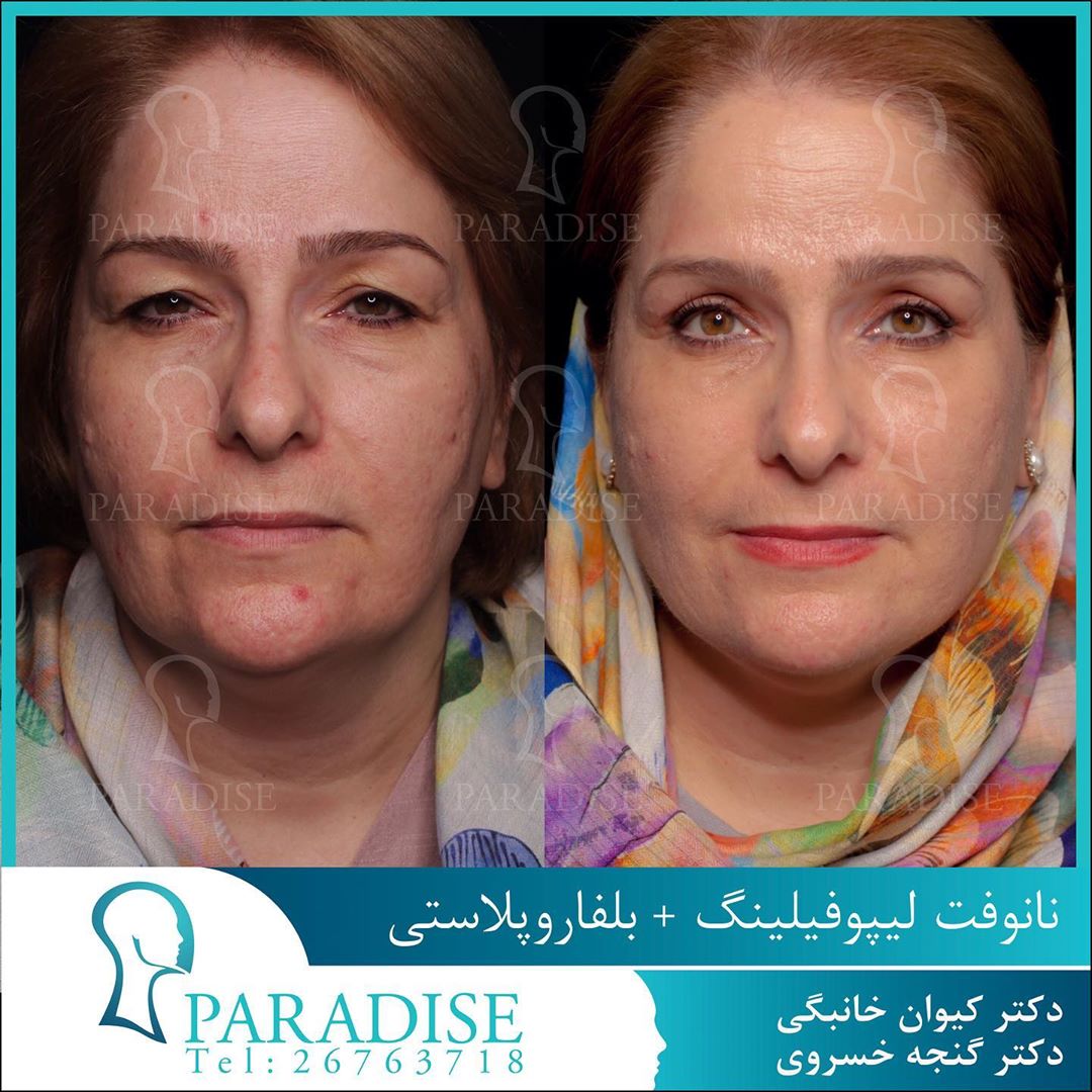 عکس قبل و بعد از عمل بلفارو پلاستی دکتر هومن گنجه خسروی