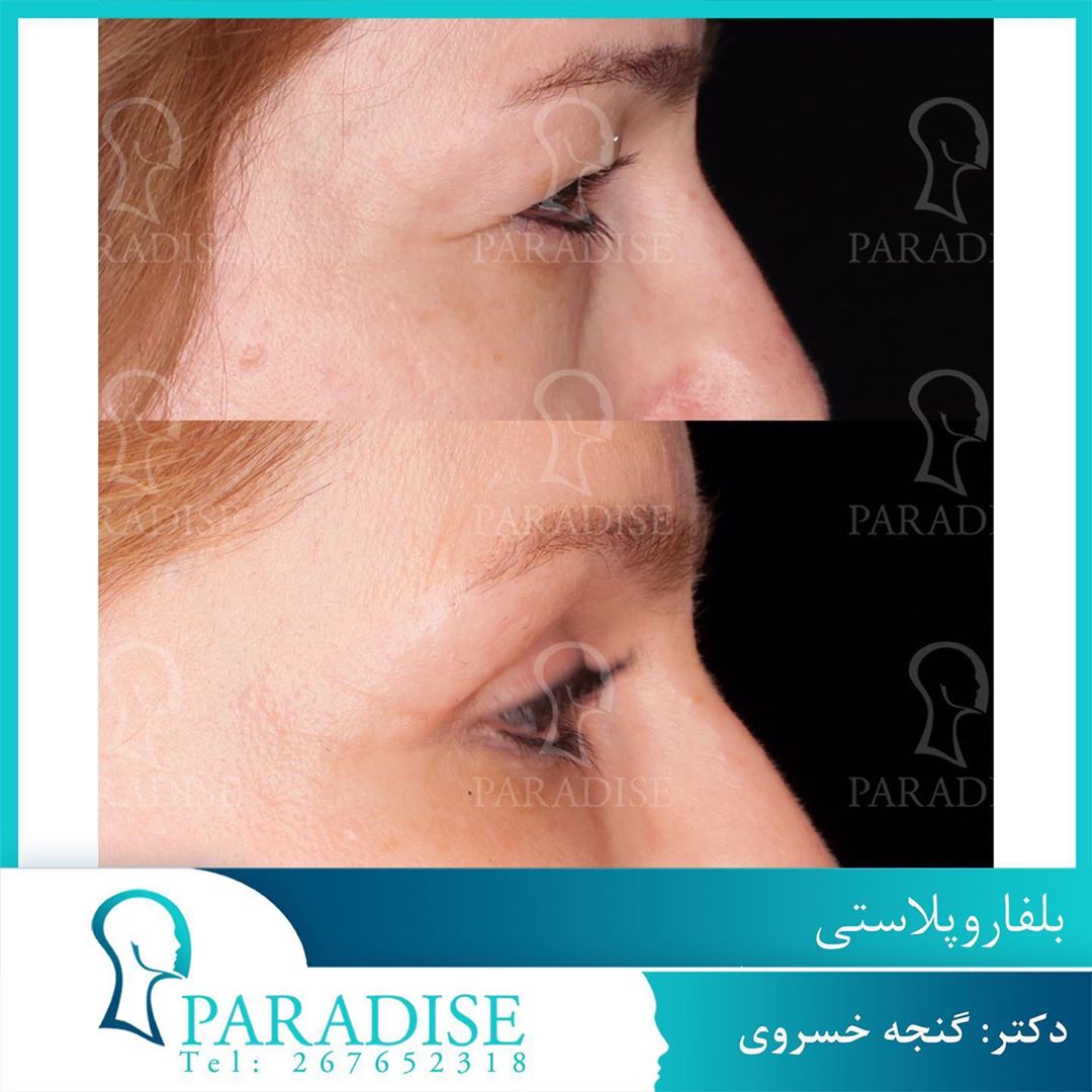عکس قبل و بعد از عمل بلفارو پلاستی دکتر هومن گنجه خسروی