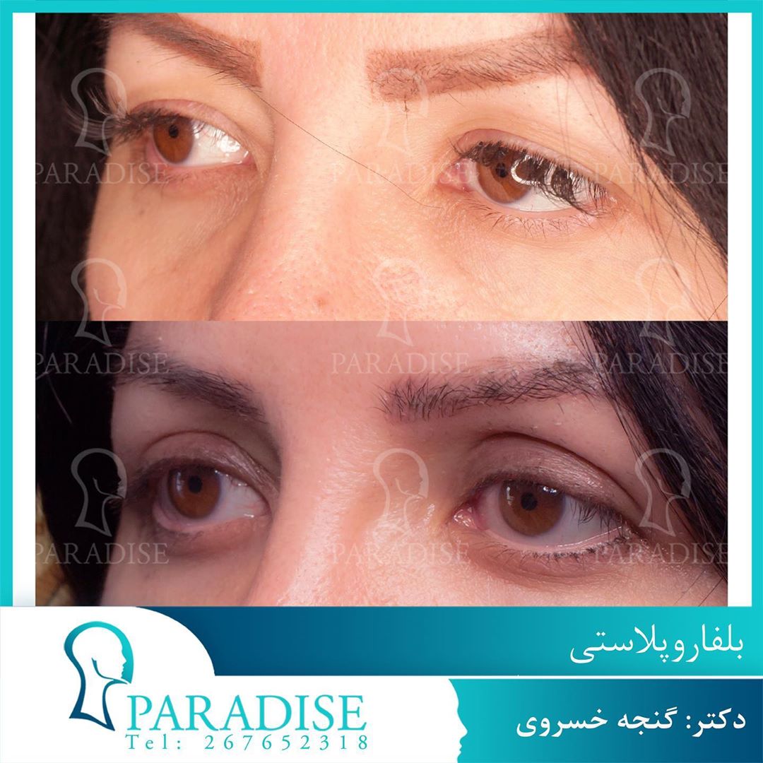 عکس قبل و بعد از عمل بلفارو پلاستی دکتر هومن گنجه خسروی