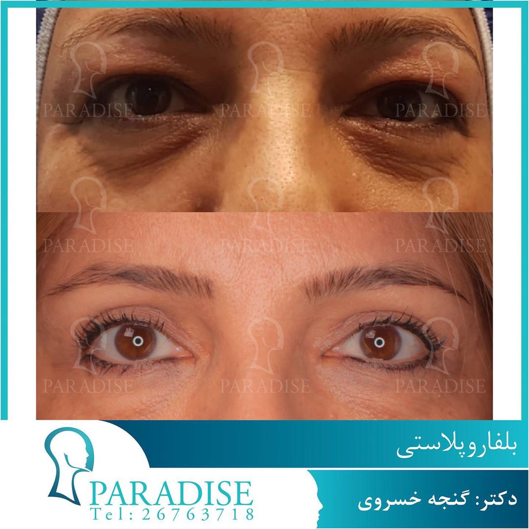 عکس قبل و بعد از عمل بلفارو پلاستی دکتر هومن گنجه خسروی