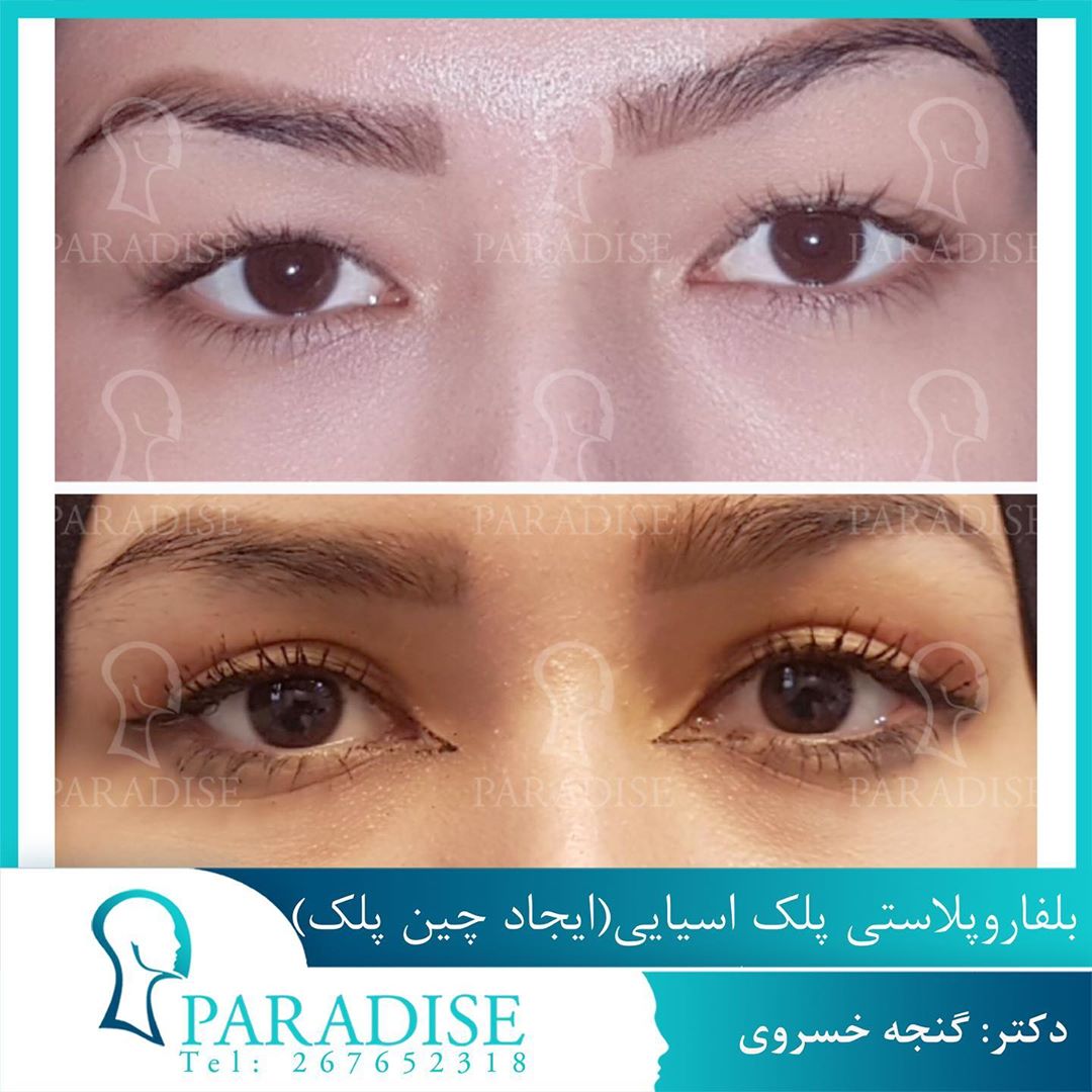 عکس قبل و بعد از عمل بلفارو پلاستی دکتر هومن گنجه خسروی