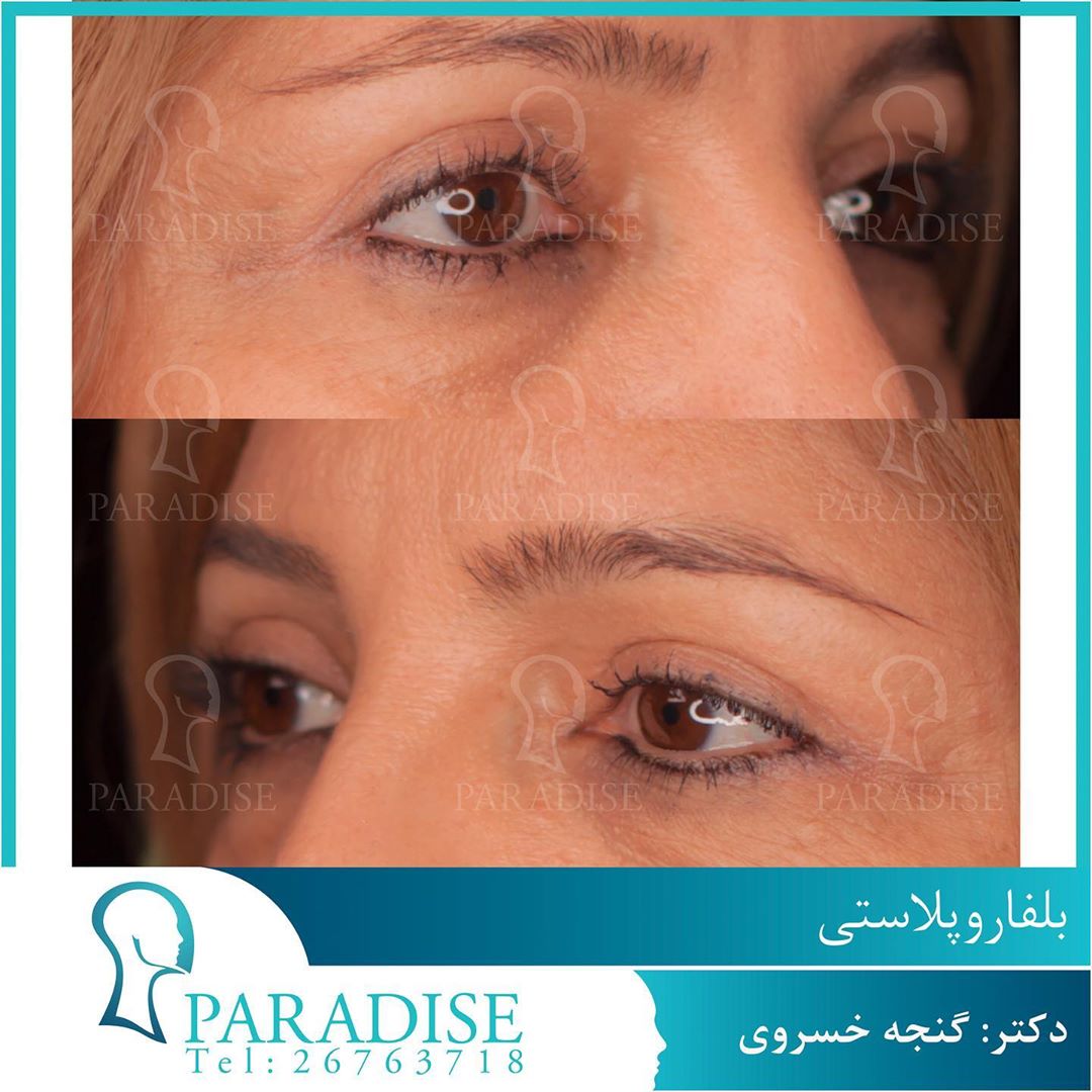 عکس قبل و بعد از عمل بلفارو پلاستی دکتر هومن گنجه خسروی