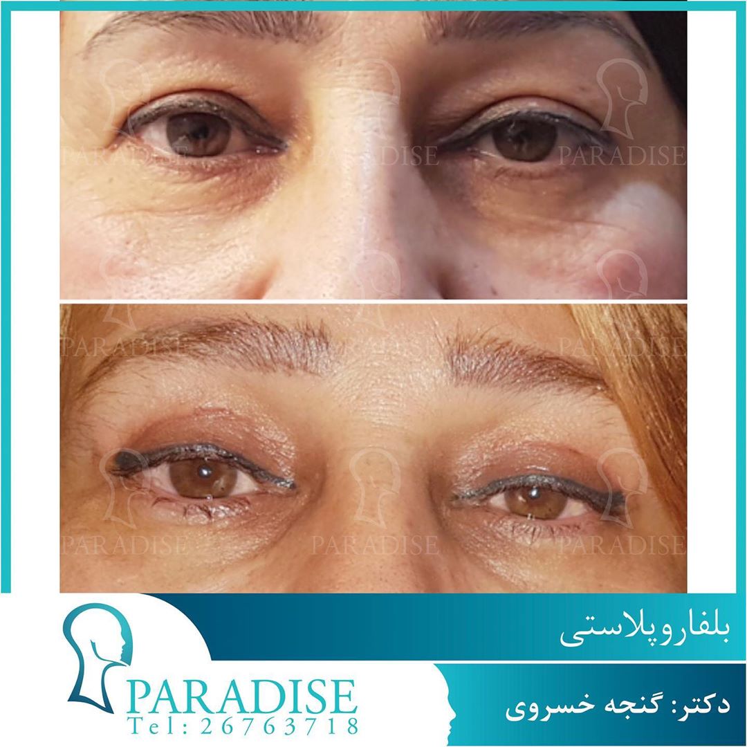 عکس قبل و بعد از عمل بلفارو پلاستی دکتر هومن گنجه خسروی
