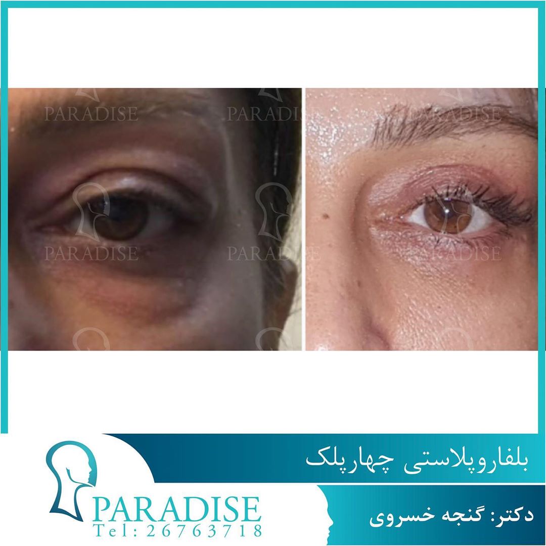 عکس قبل و بعد از عمل بلفارو پلاستی دکتر هومن گنجه خسروی