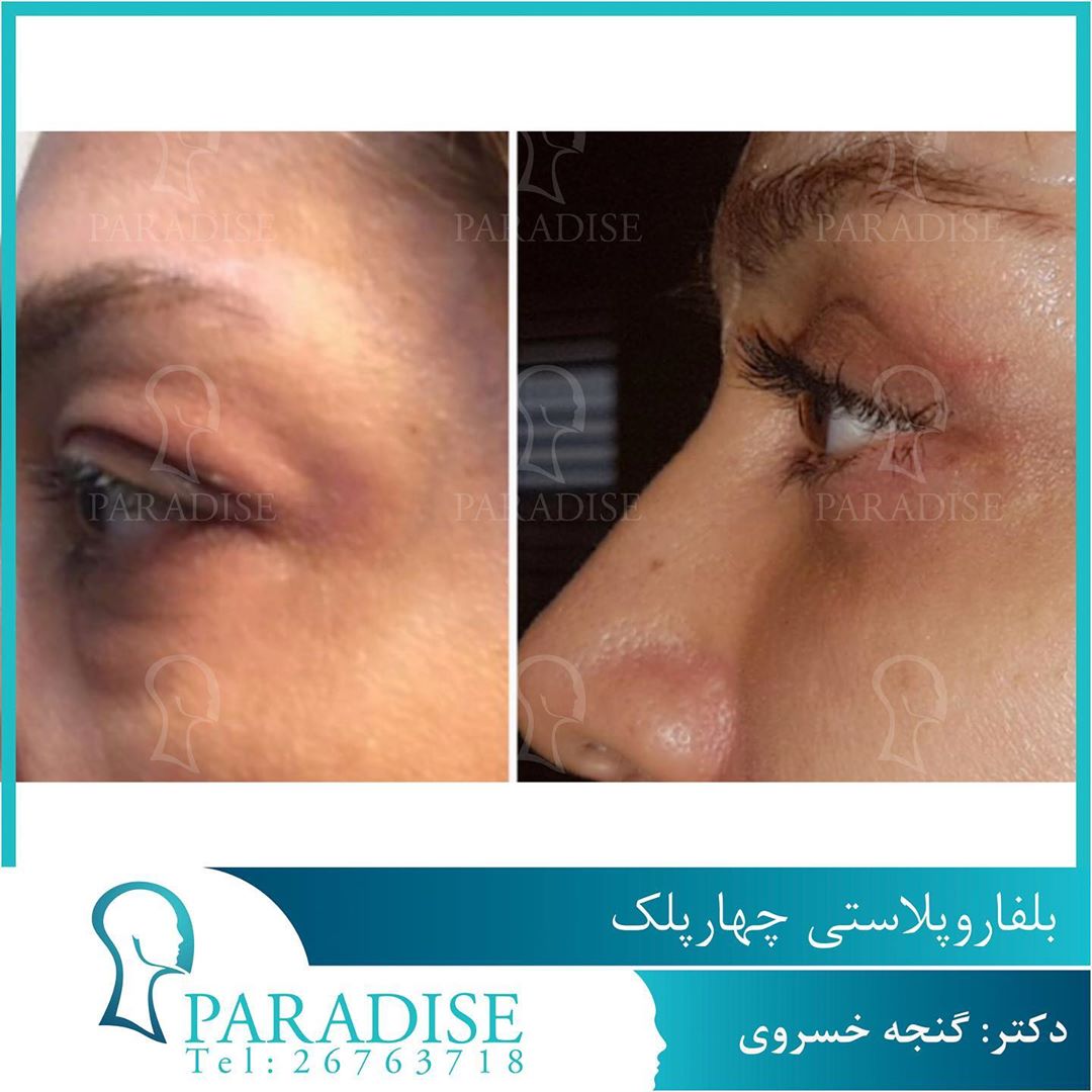 عکس قبل و بعد از عمل بلفارو پلاستی دکتر هومن گنجه خسروی