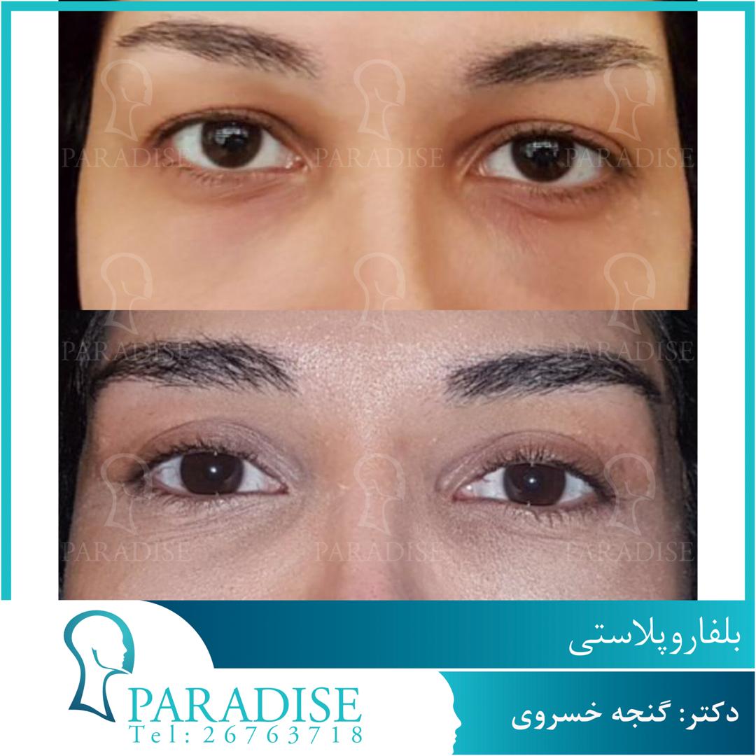 عمل زیبایی پلک بلفاروپلاستی