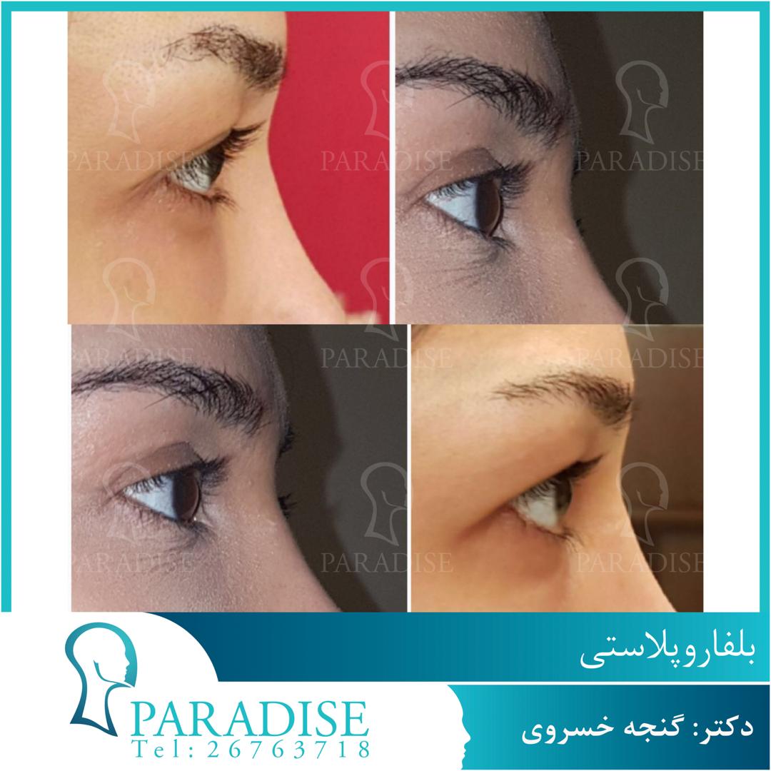 عمل زیبایی پلک بلفاروپلاستی