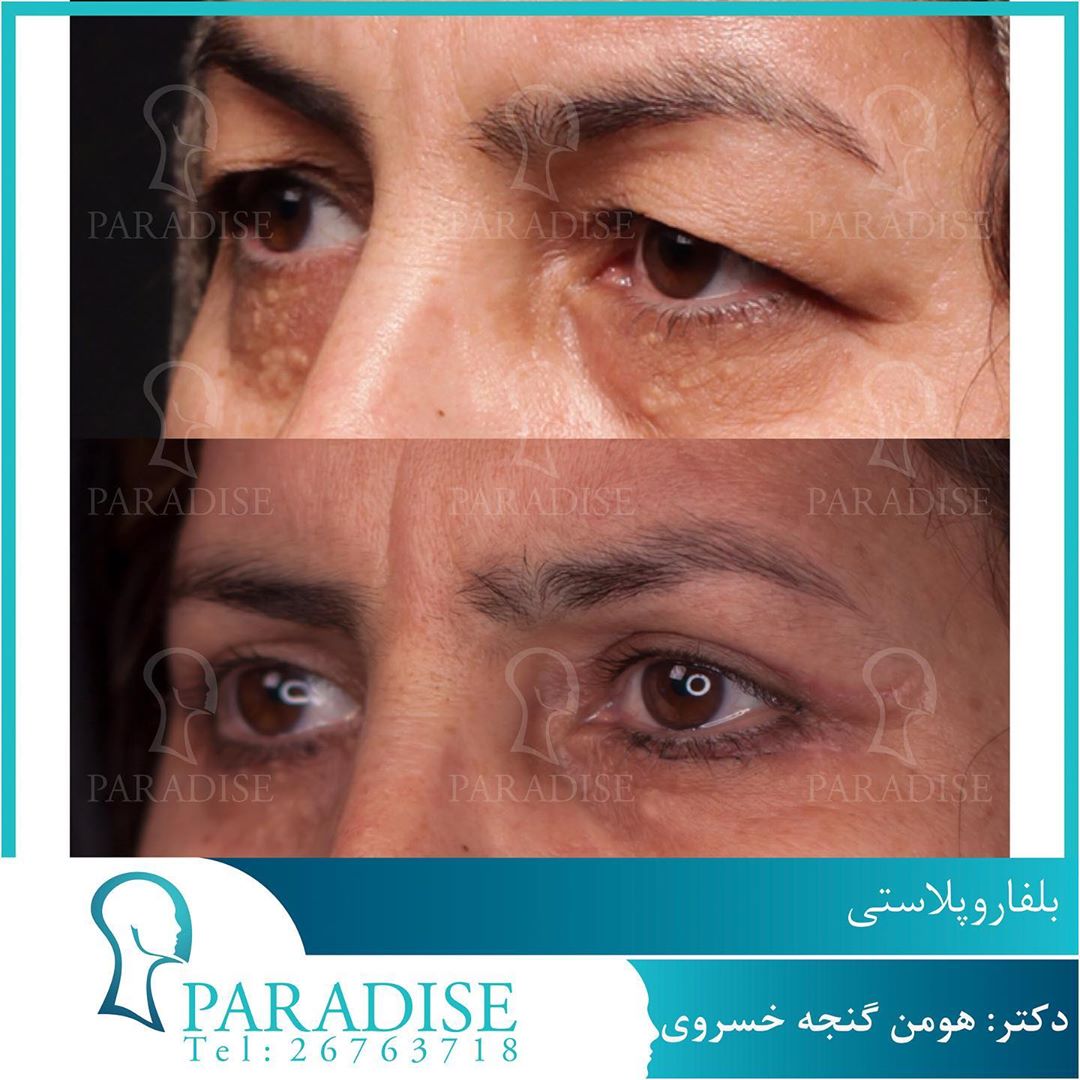 بلفاروپلاستی دکتر هومن گنجه خسروی