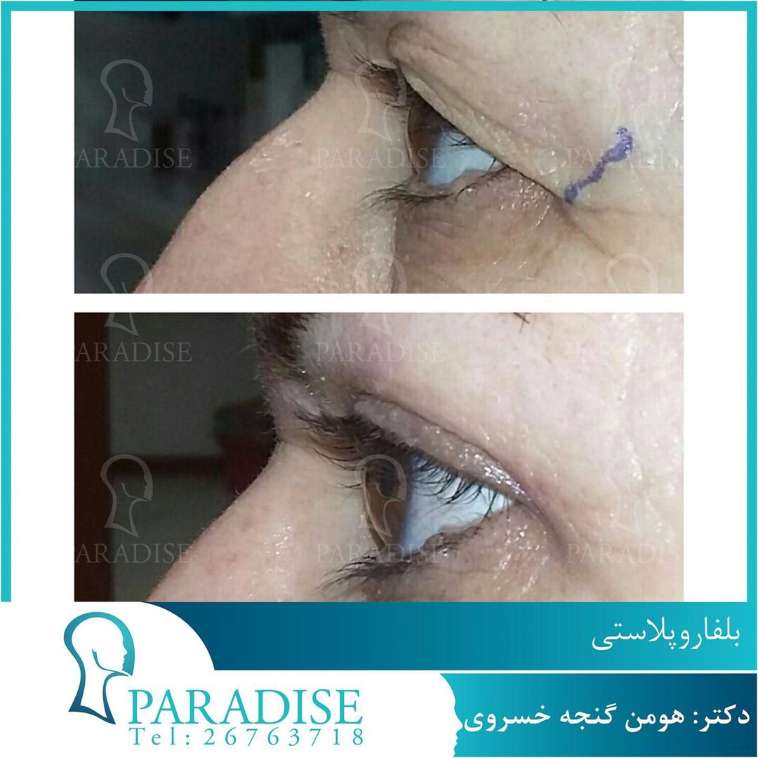 بلفاروپلاستی دکتر هومن گنجه خسروی