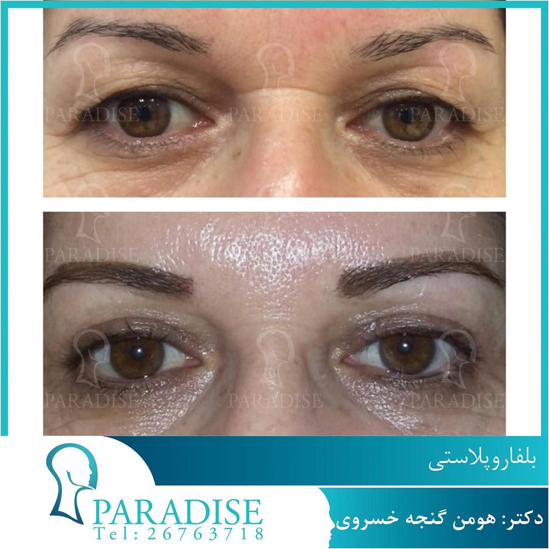 بلفاروپلاستی دکتر هومن گنجه خسروی