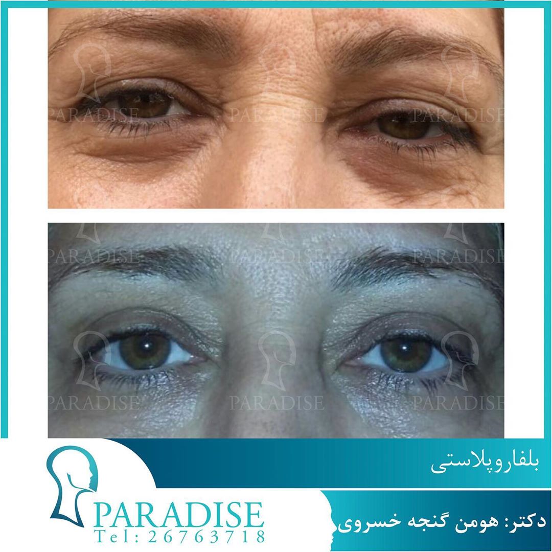 بلفاروپلاستی دکتر هومن گنجه خسروی