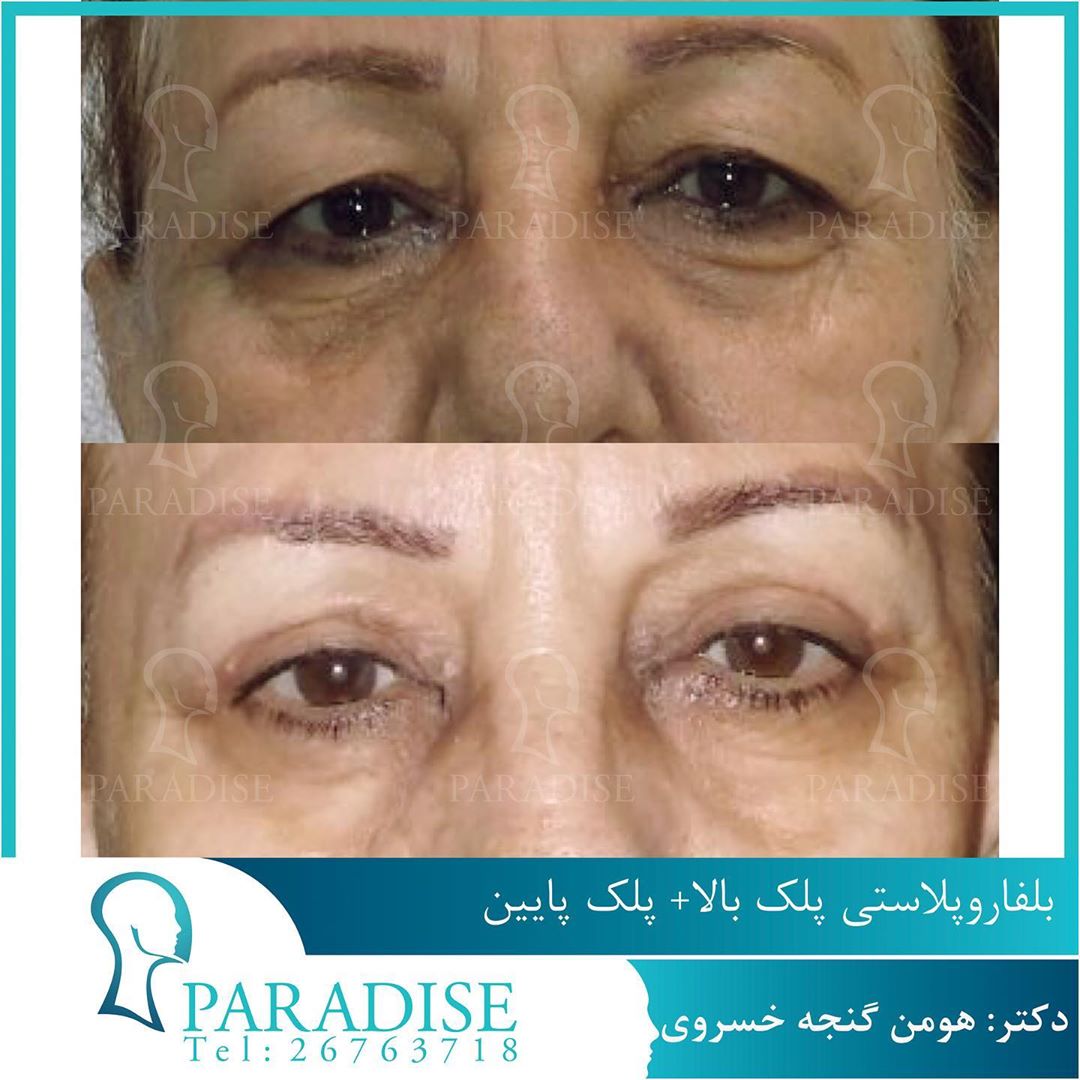 بلفاروپلاستی دکتر هومن گنجه خسروی