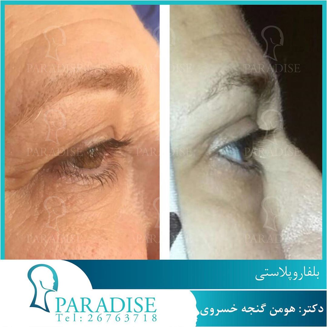 بلفاروپلاستی دکتر هومن گنجه خسروی