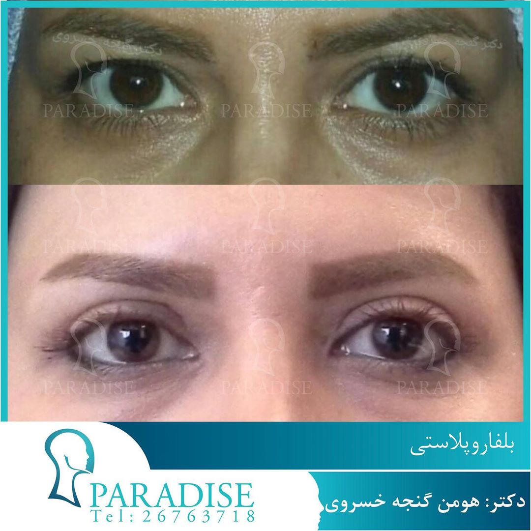 بلفاروپلاستی دکتر هومن گنجه خسروی