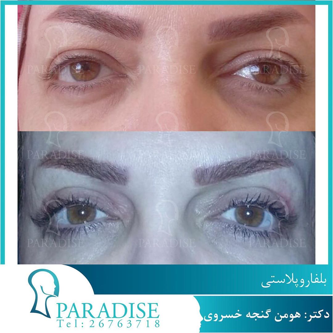 بلفاروپلاستی دکتر هومن گنجه خسروی