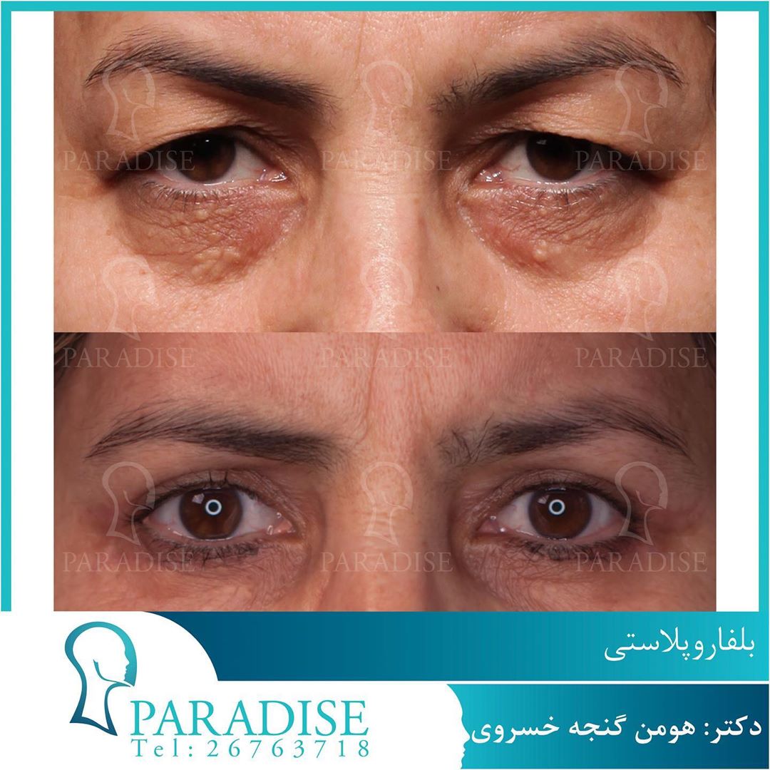 بلفاروپلاستی دکتر هومن گنجه خسروی